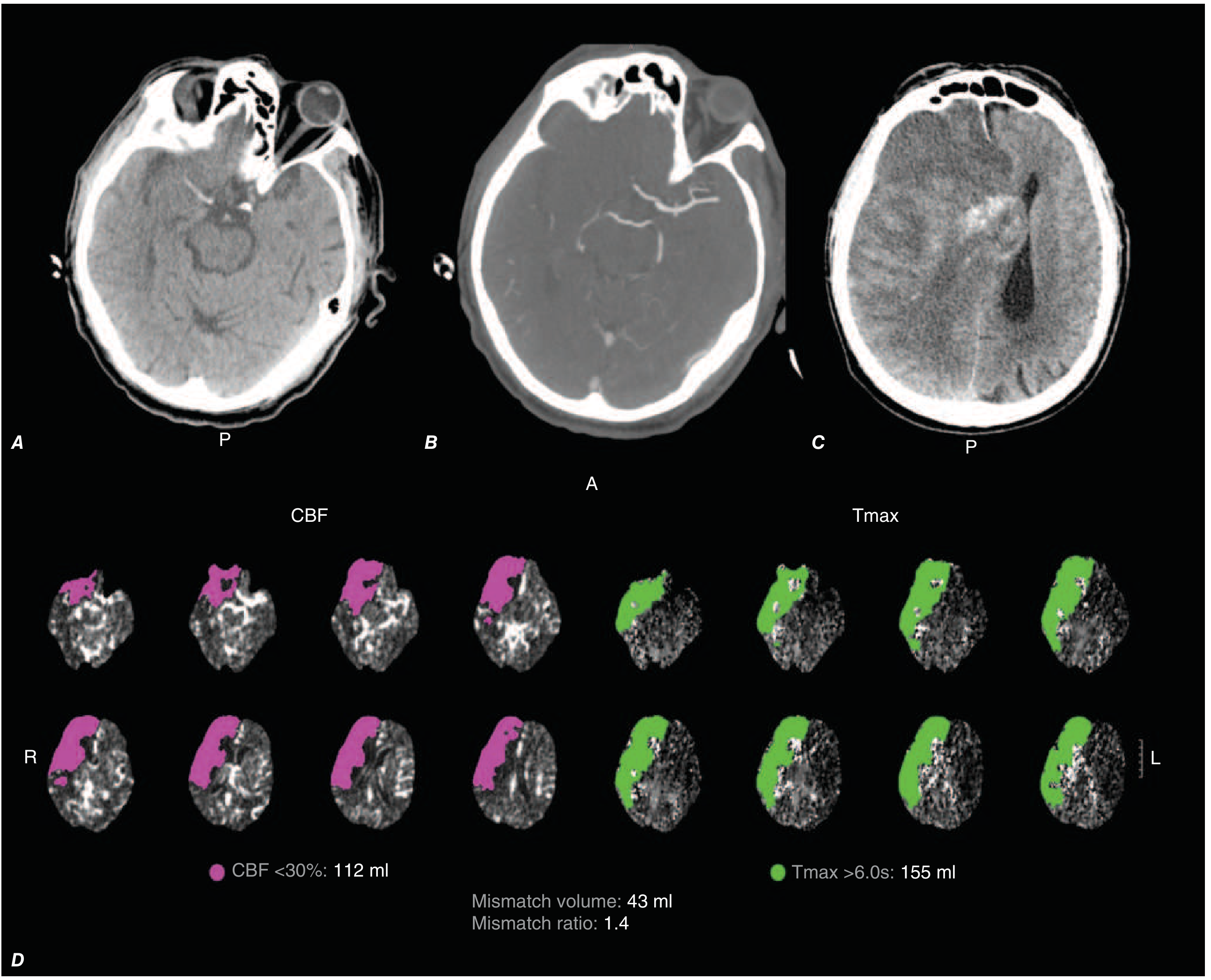 Harrison's FIGURE 437-12 - CT/CTA/CT perfusion in right MCA occlusion with core-penumbra mismatch