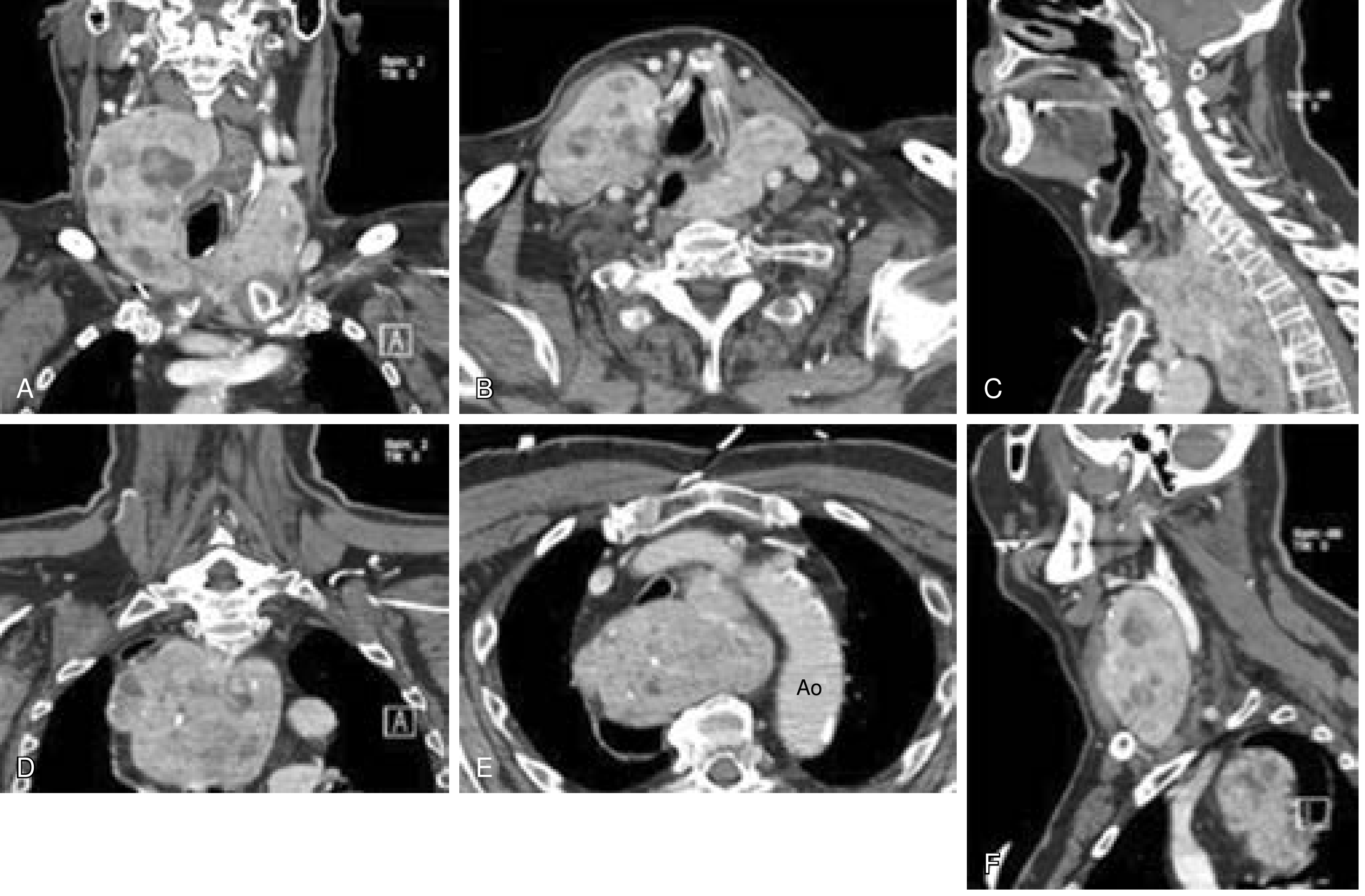 CT scans of massive multinodular goiter with retrosternal extension in an 82-year-old man