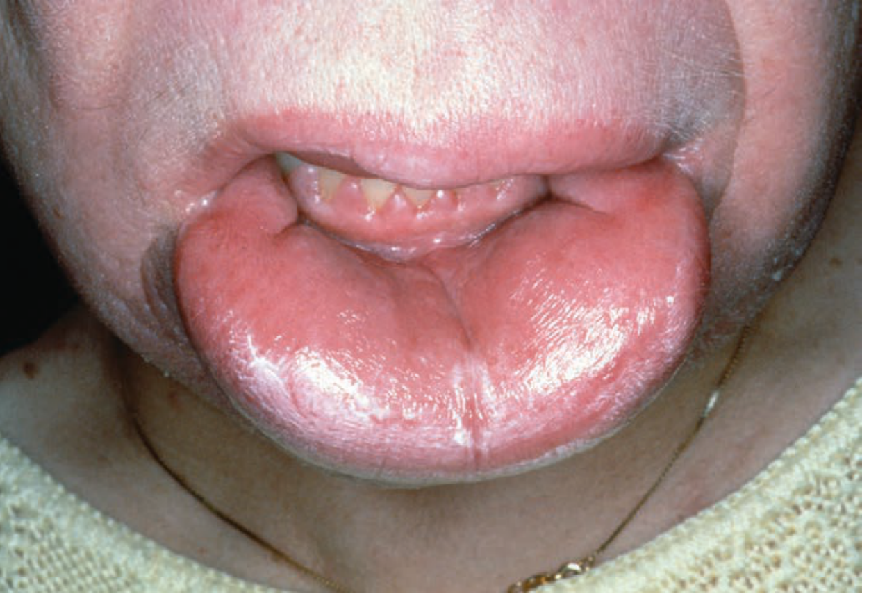 Melkersson-Rosenthal syndrome - lip swelling