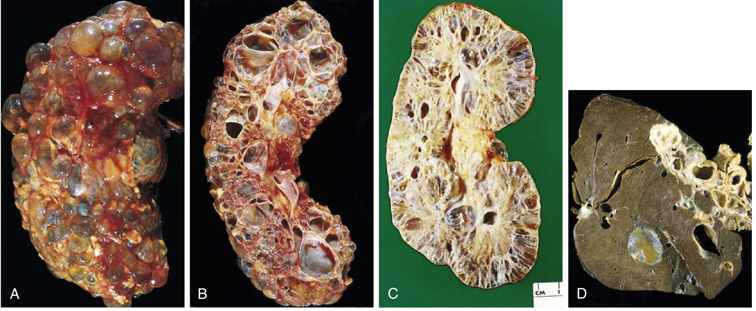 Polycystic kidney disease pathology - (A, B) ADPKD external surface and bisected section showing numerous large cysts; (C) ARPKD cross-section showing smaller, uniformly distributed cysts and dilated channels perpendicular to cortical surface; (D) associated liver cysts