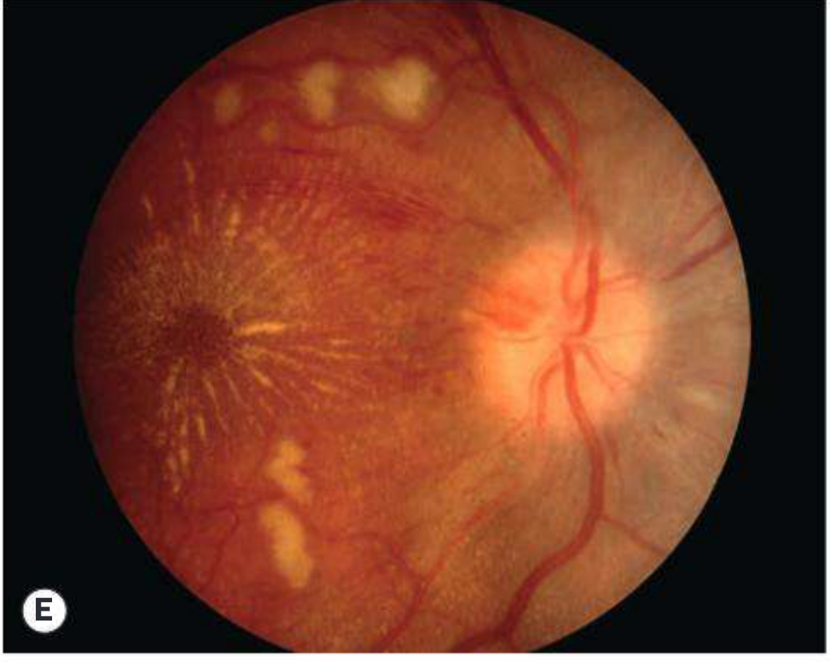 Kanski Fig. 13.43 - Hypertensive retinopathy stages A-F