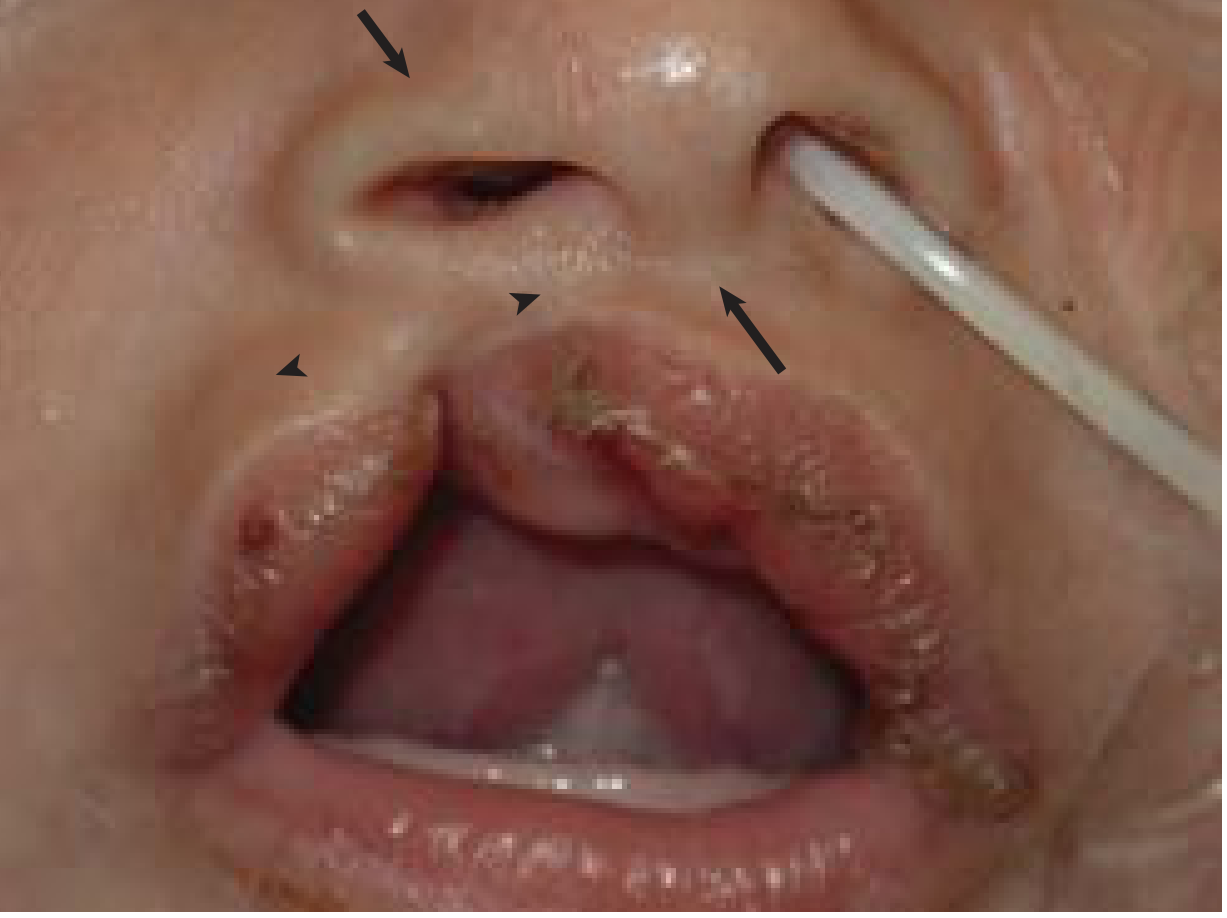 Incomplete right cleft lip showing Simonart band with associated columellar and alar deformity