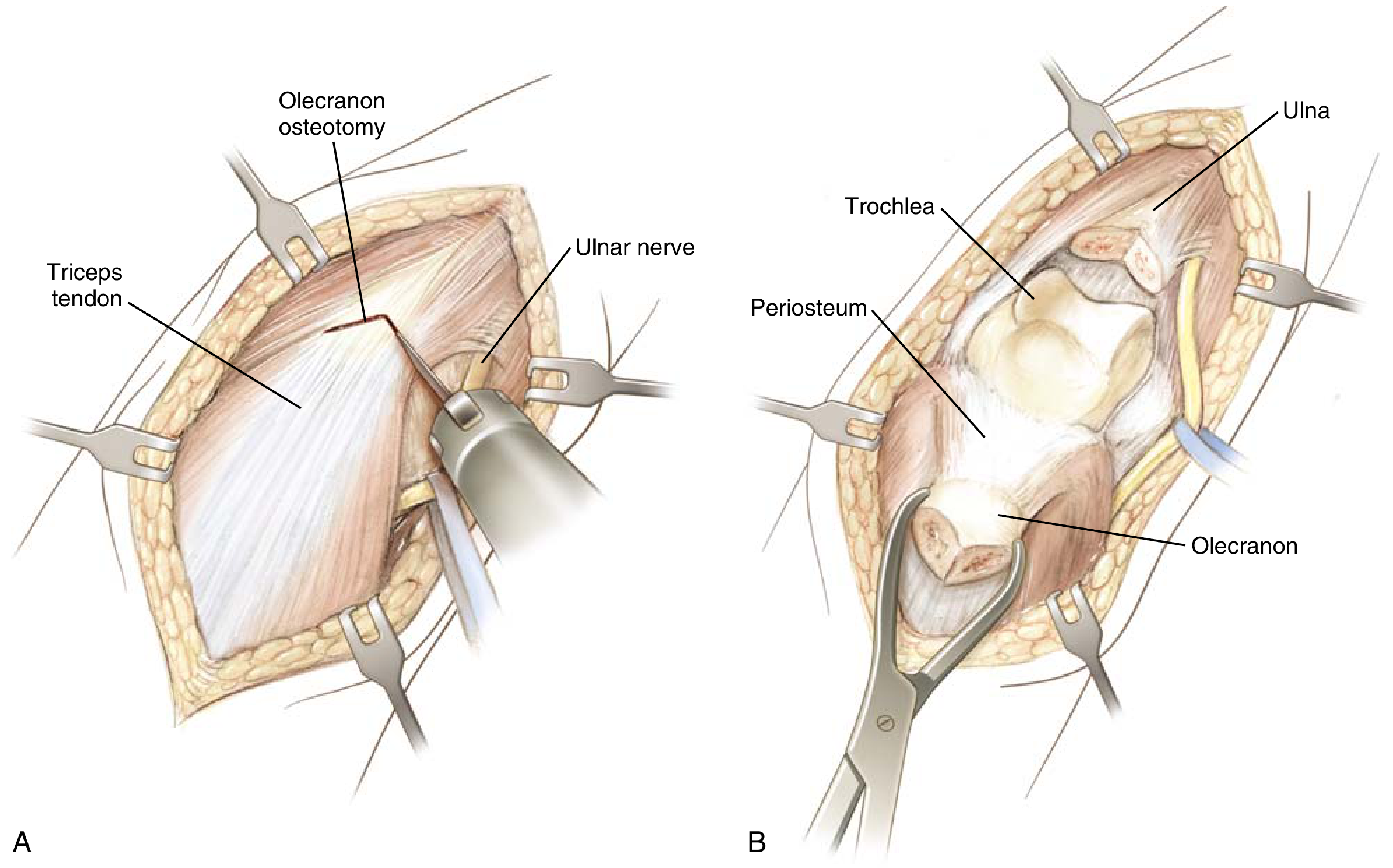 Posterior approach to elbow: (A) Superficial exposure showing olecranon osteotomy and ulnar nerve. (B) Deep exposure revealing trochlea, periosteum, and olecranon