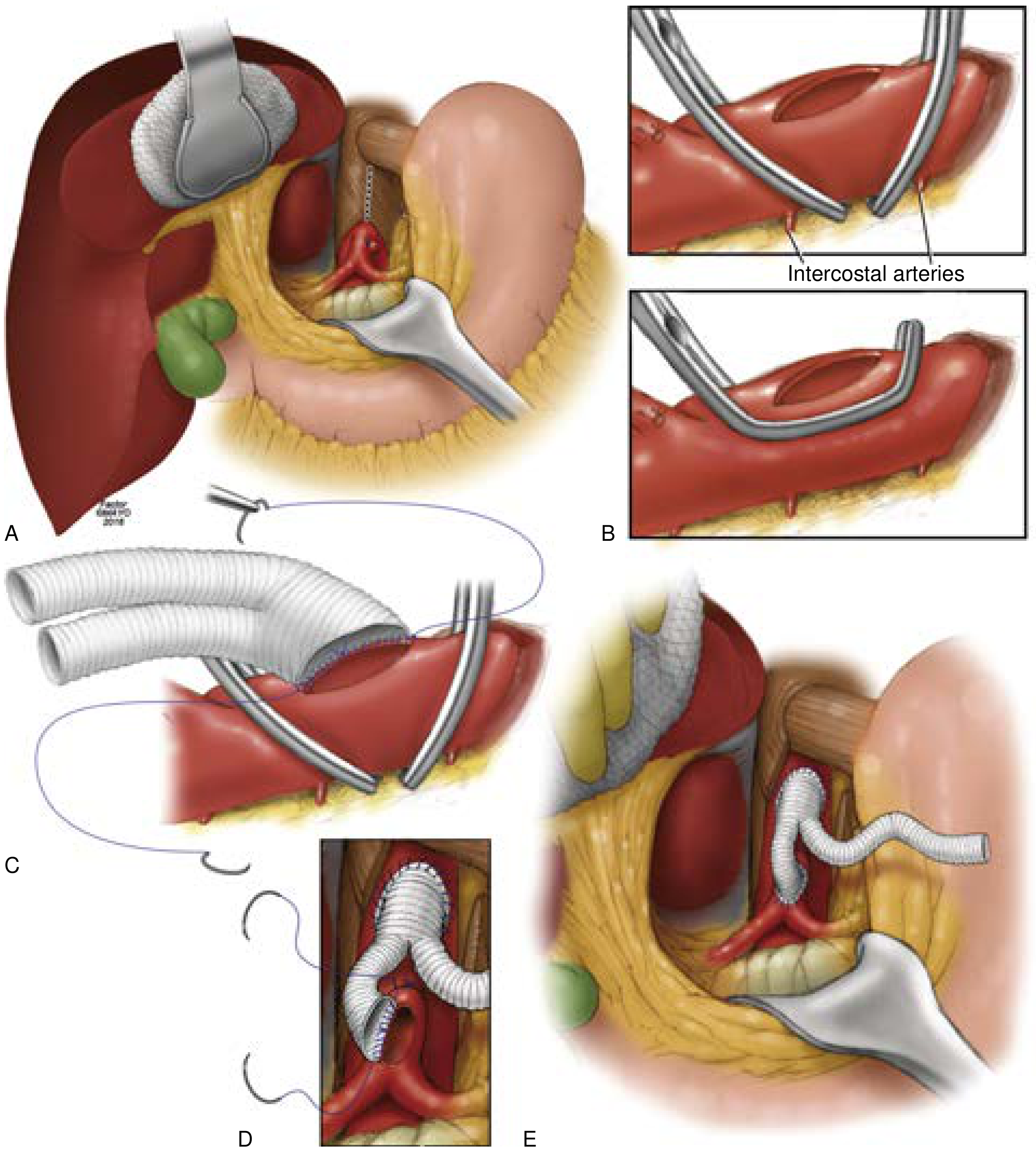 FIG. 7 — Supraceliac antegrade bypass