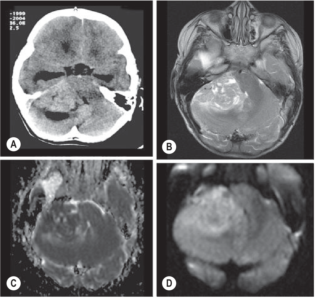 Medulloblastoma - CT hyperdense mass (A), T2 hypointense (B), ADC restricted (C), DWI bright (D): classic features differentiating it from other posterior fossa tumors