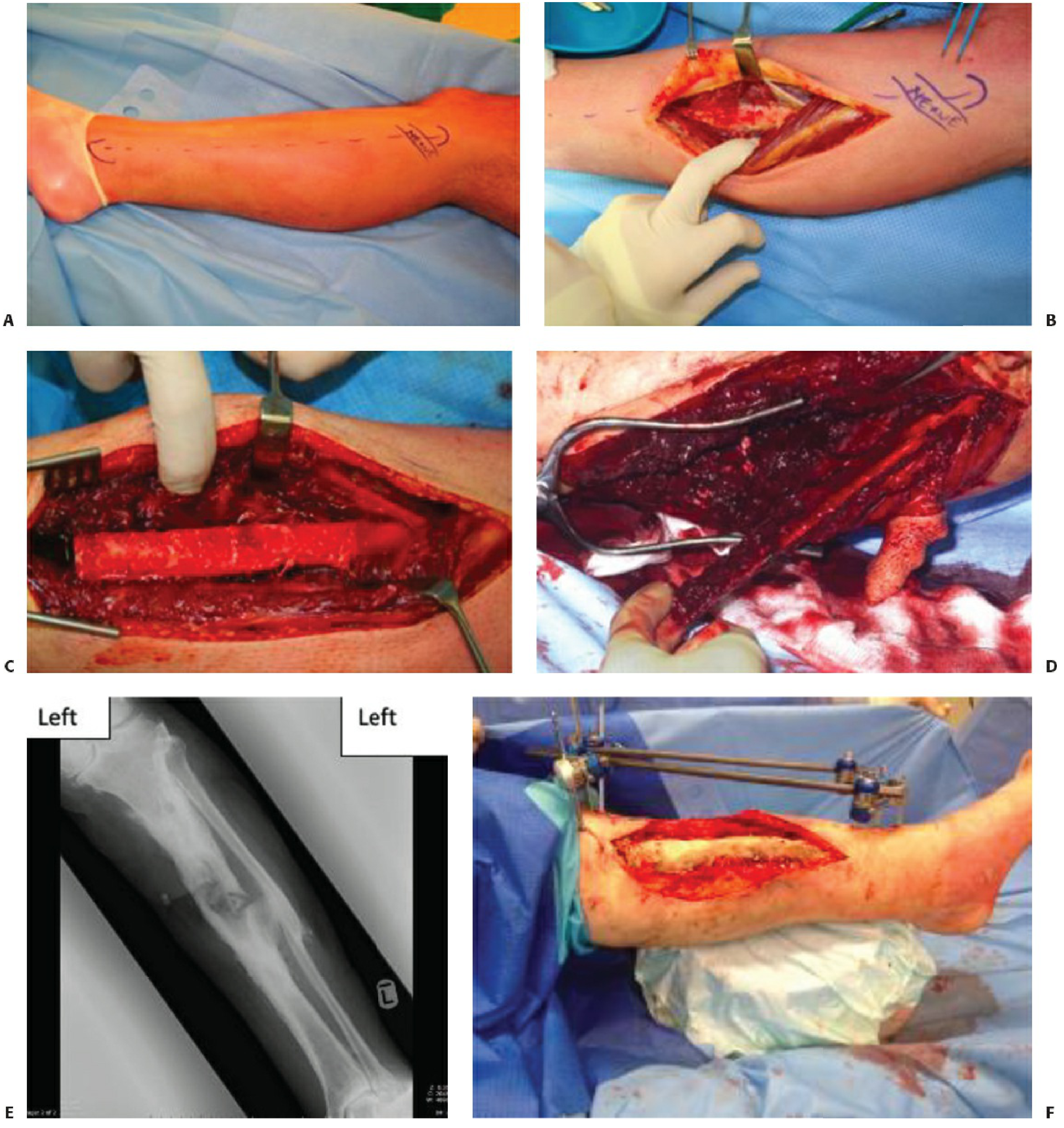 Free fibula flap harvest steps - marking, dissection, bone cuts, mobilization