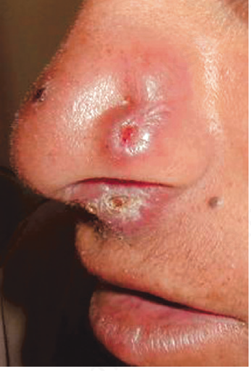 Rhinoscleroma - granulomatous lesion of the nose with hard, inflamed nodular lesion and crusting