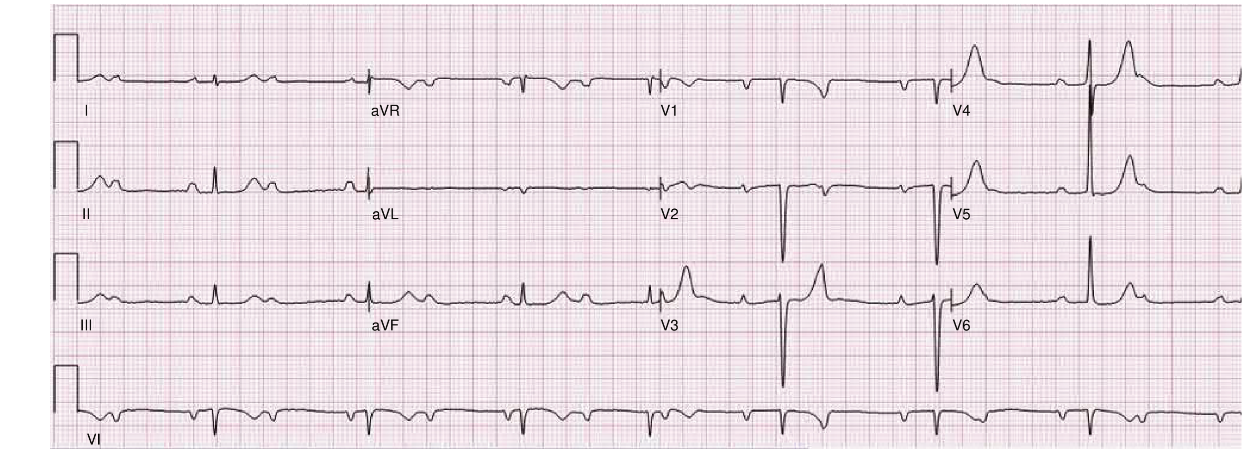 Complete AV Block ECG - Braunwald's Heart Disease