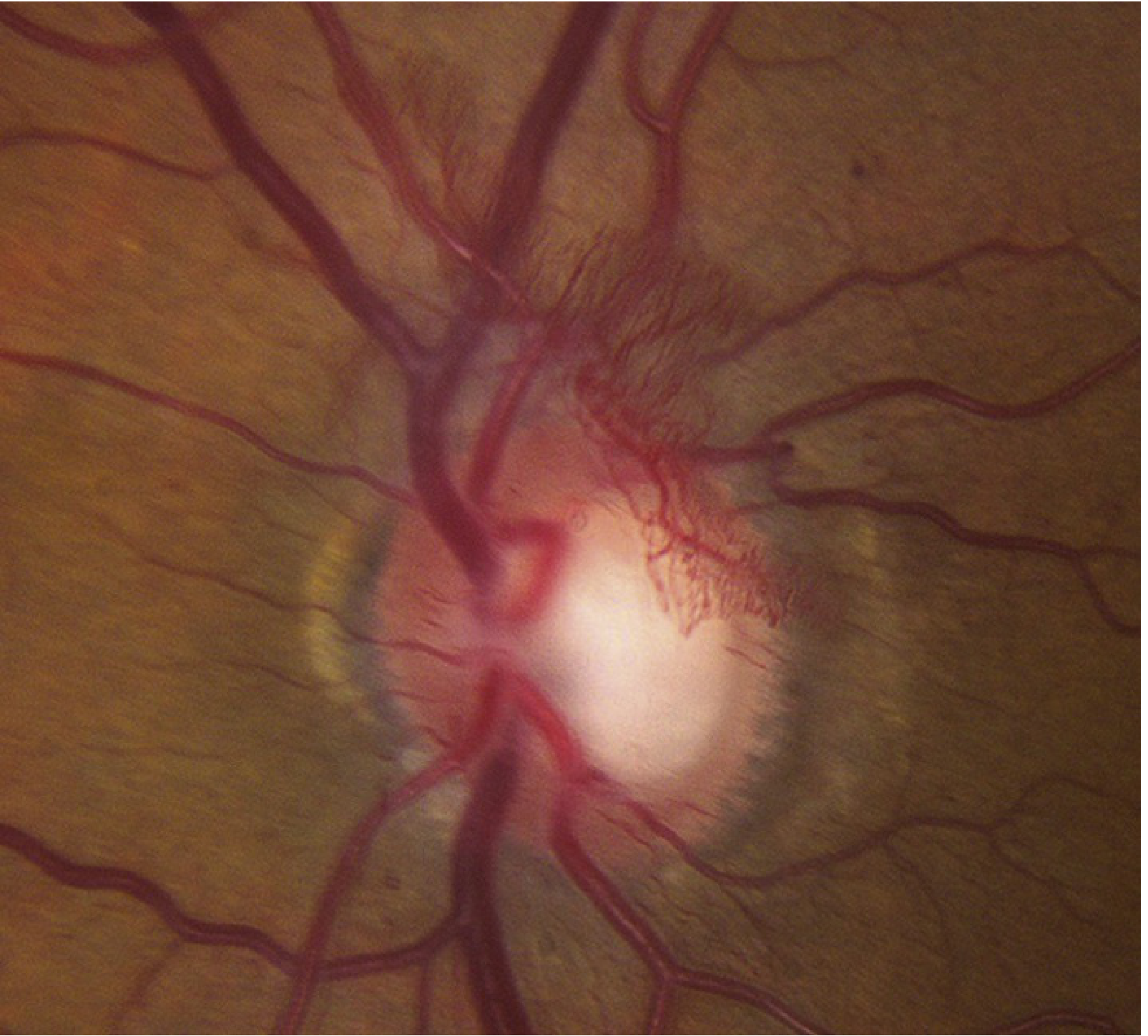 Proliferative DR with NVD