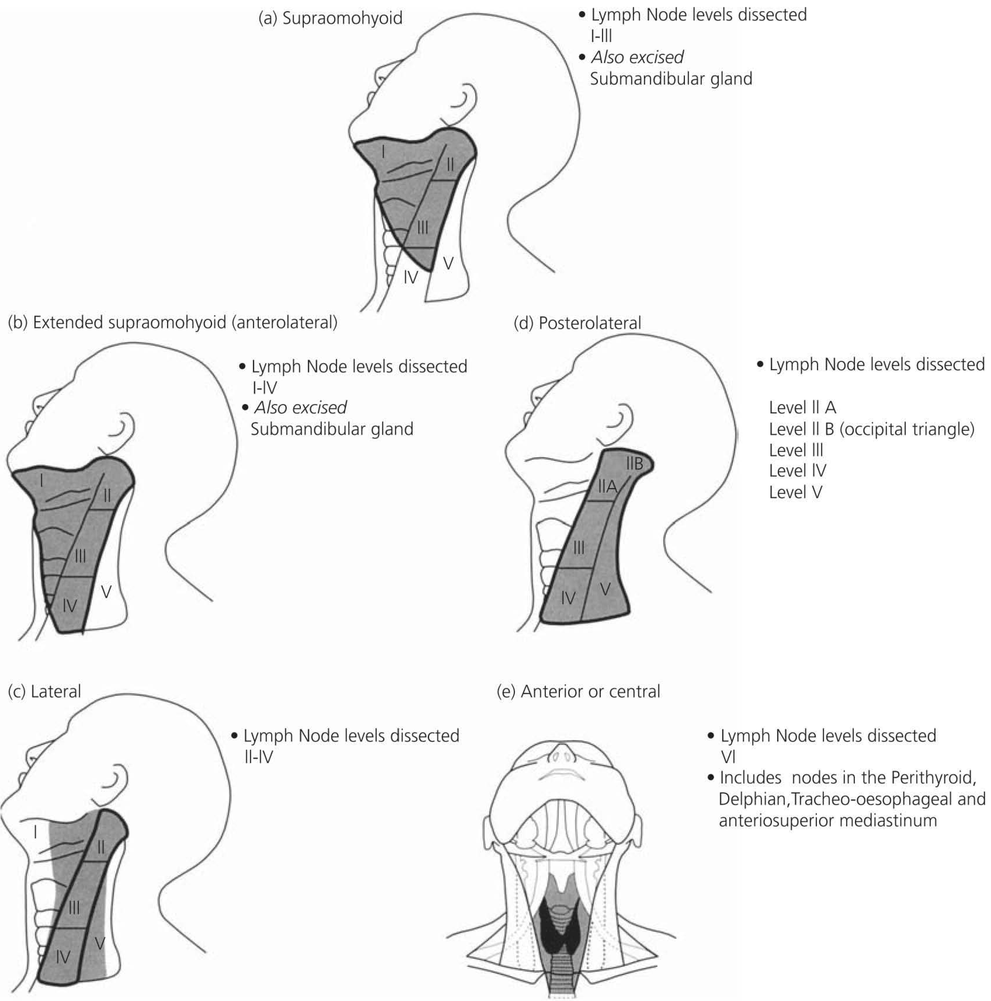 Types of selective neck dissection - diagram showing lymph node levels I-VI