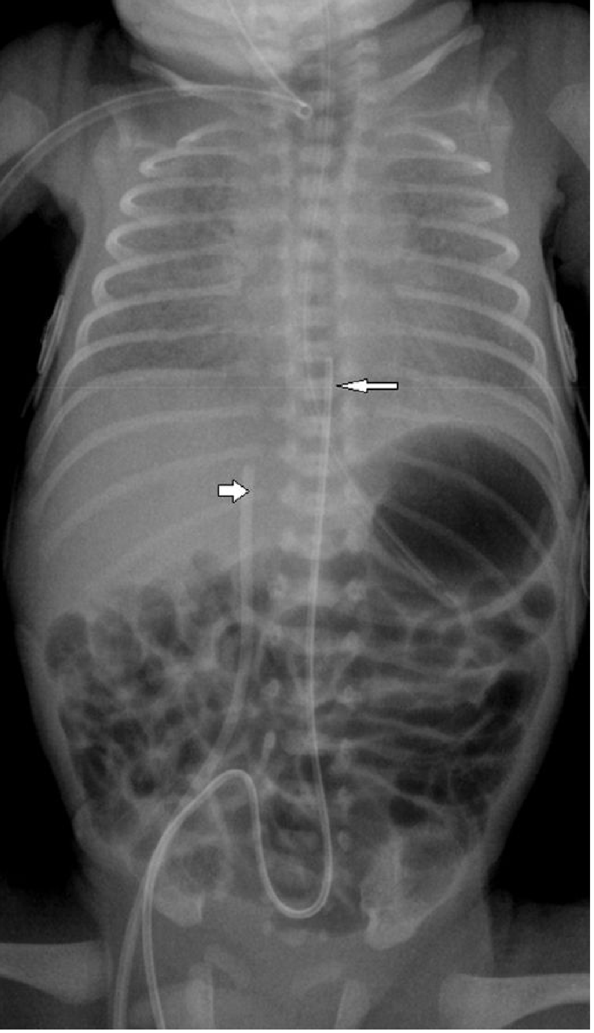 UAC tip at T7 and UVC tip at IVC-RA junction on neonatal chest X-ray