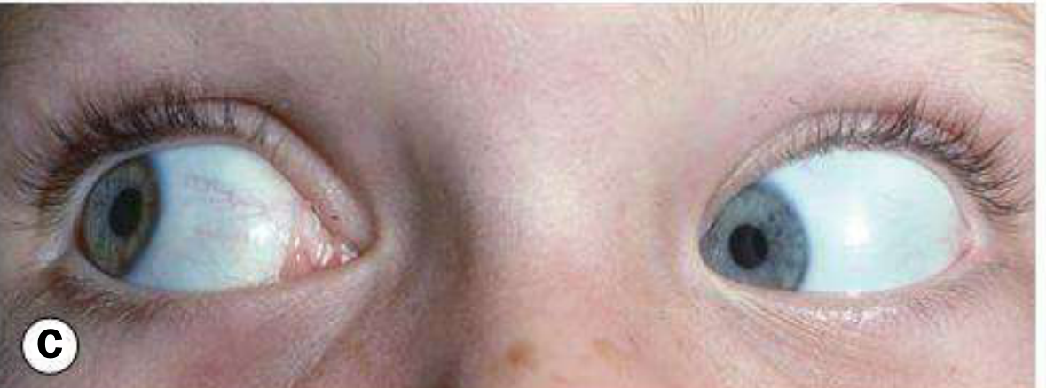 Left Brown syndrome - down-shoot in adduction, Panel C from Kanski's Clinical Ophthalmology