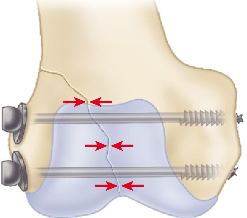 Lag screw applied across a fracture - red arrows show interfragmentary compression forces