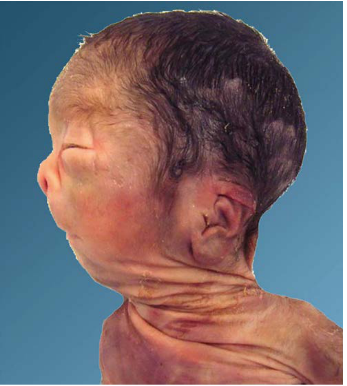 Potter facies - autopsy photograph showing flattened nose, retrognathia, and low-set ears