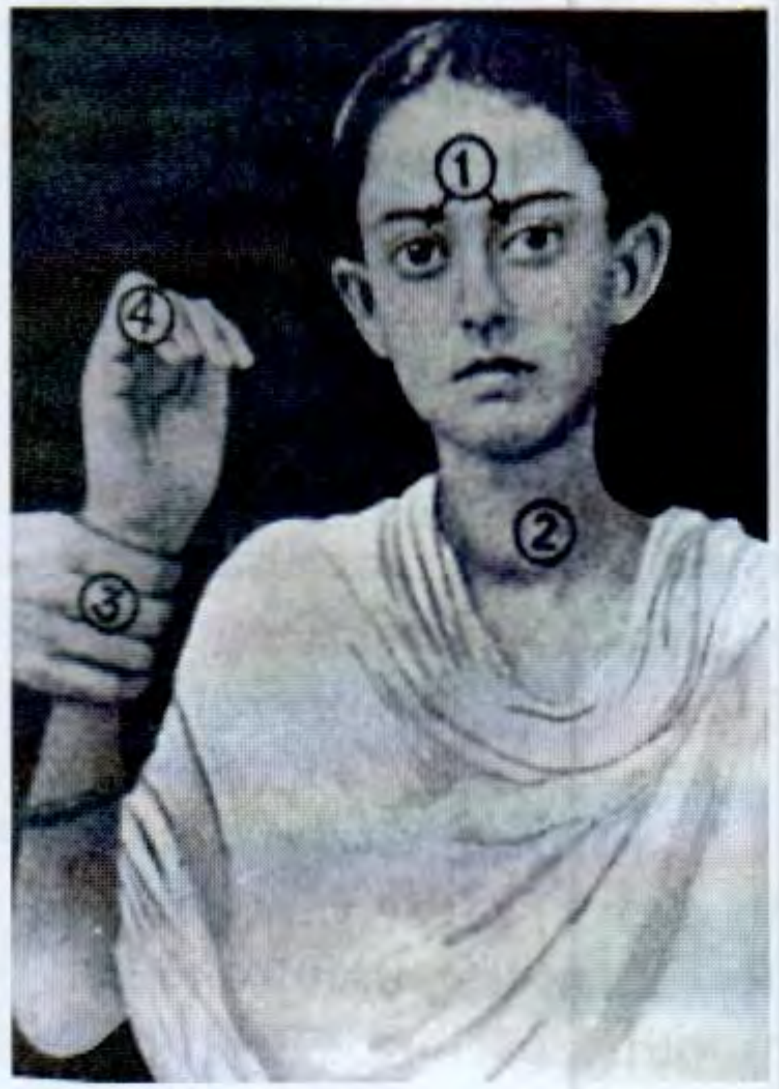 Four cardinal signs of primary toxic goitre shown by numbers: (1) exophthalmos; (2) thyroid swelling; (3) tachycardia; (4) tremor