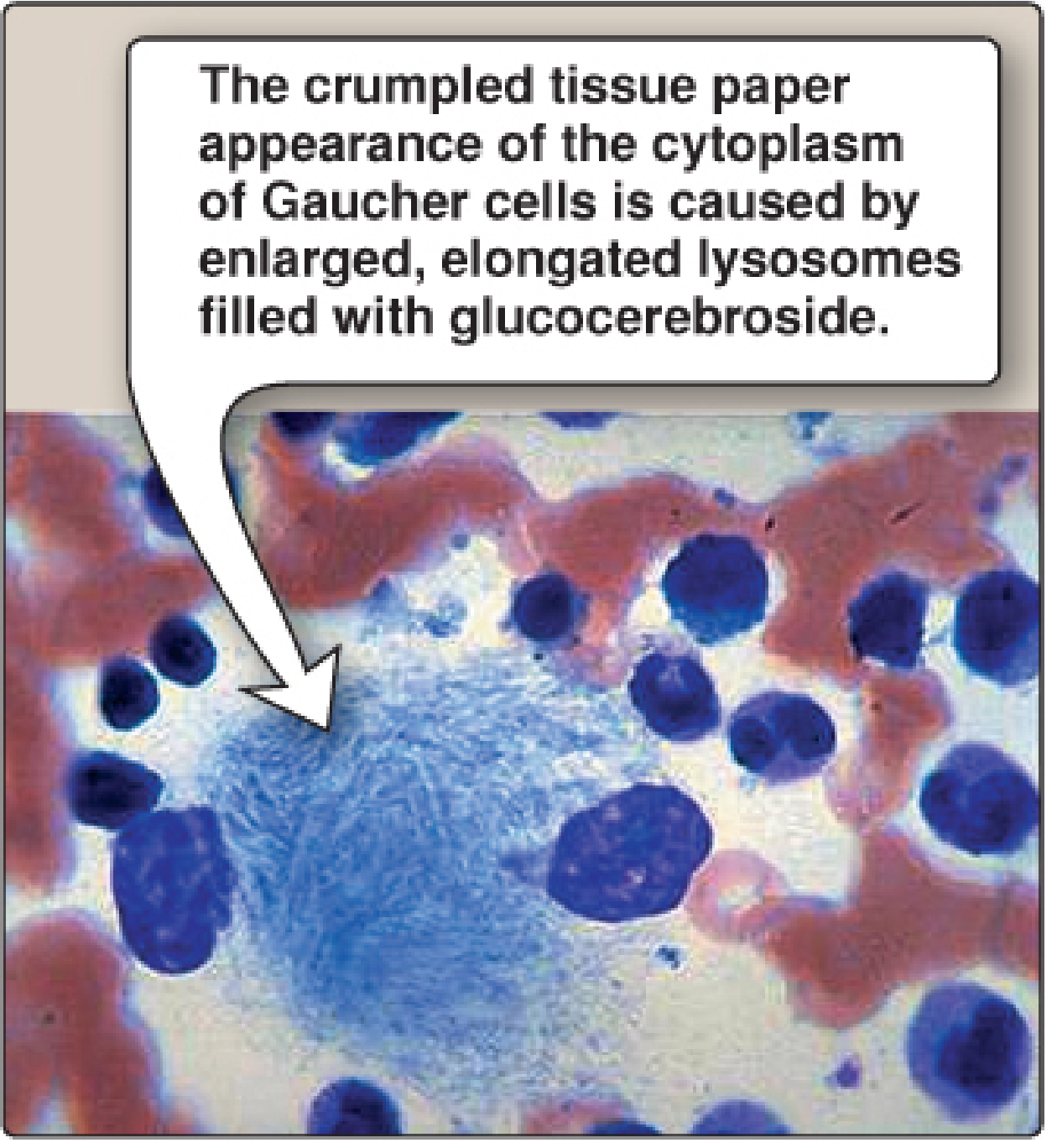 Gaucher cell (bone marrow aspirate, Wright stain) - large macrophage with crumpled-tissue-paper cytoplasm from glucocerebroside-laden lysosomes — Lippincott Illustrated Reviews: Biochemistry, 8e