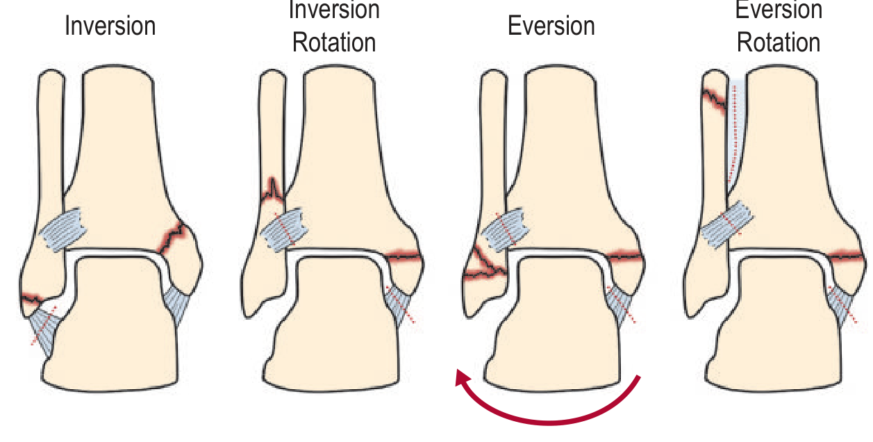 Lauge-Hansen classification of ankle fractures showing inversion, inversion rotation, eversion, and eversion rotation patterns