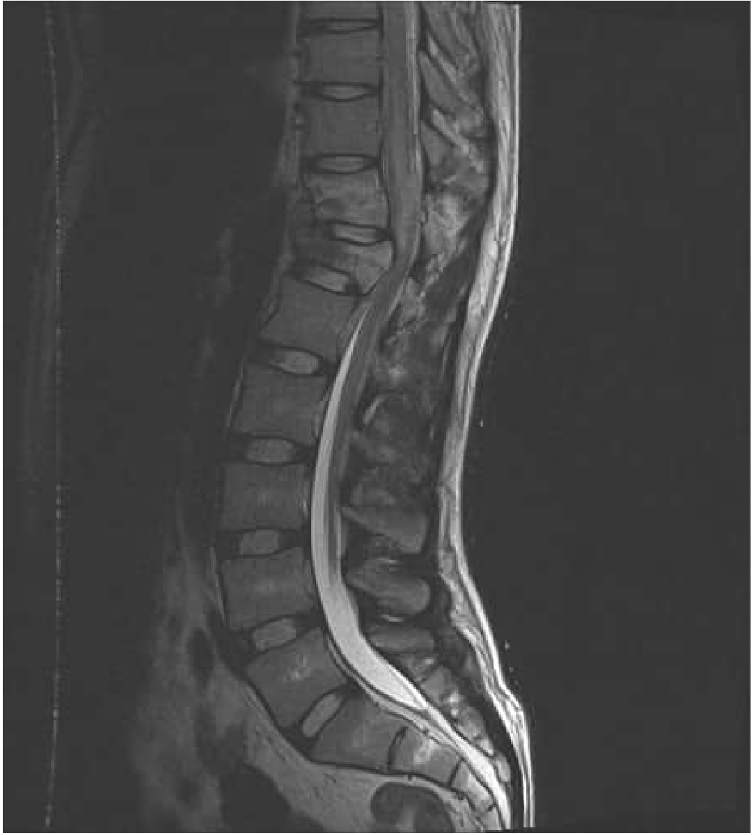 Conus Medullaris Syndrome — T2 sagittal MRI showing T12 burst fracture