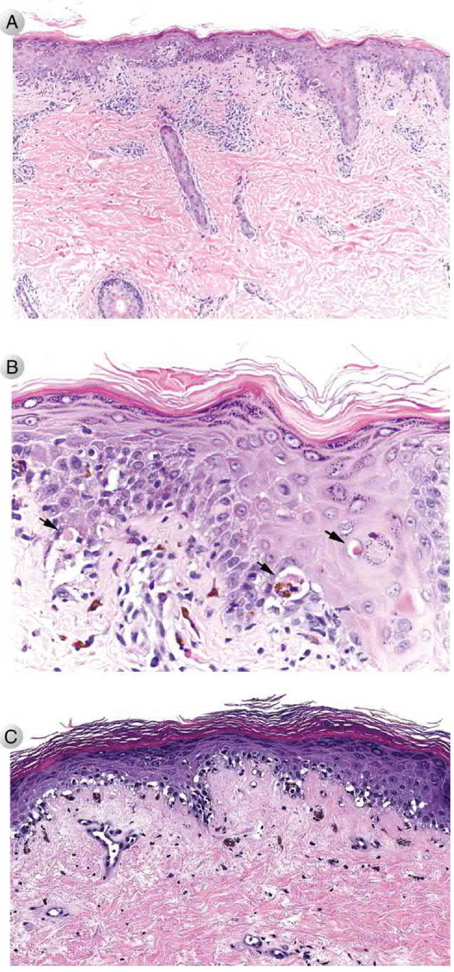 Histopathology showing sparse lymphocytic infiltrate at dermal-epidermal junction with apoptotic epidermal cells (arrows) in acute GVHD (A, B) and fibrosis in chronic GVHD (C)