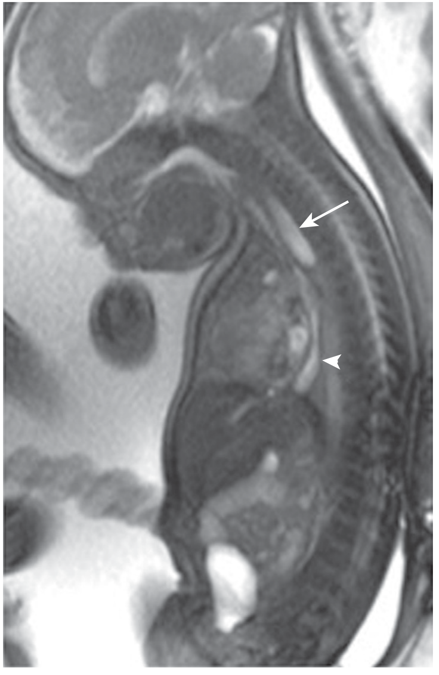 Sagittal fetal MRI showing proximal esophageal blind pouch (arrow) and distal esophagus (arrowhead) in EA