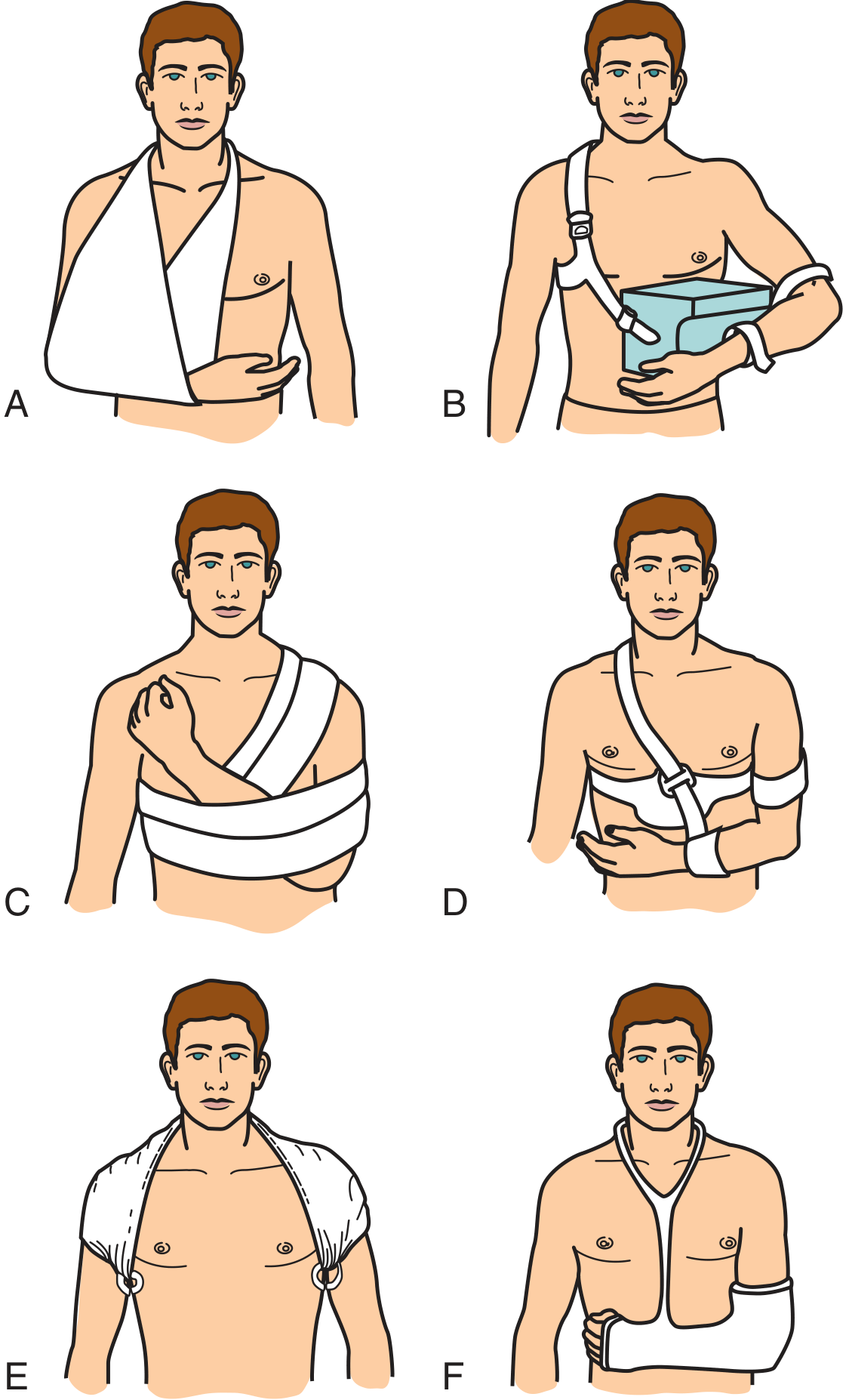 Methods of shoulder immobilization - sling, abduction pillow immobilizer, sling-and-swathe, shoulder immobilizer, figure-of-eight, hanging cast