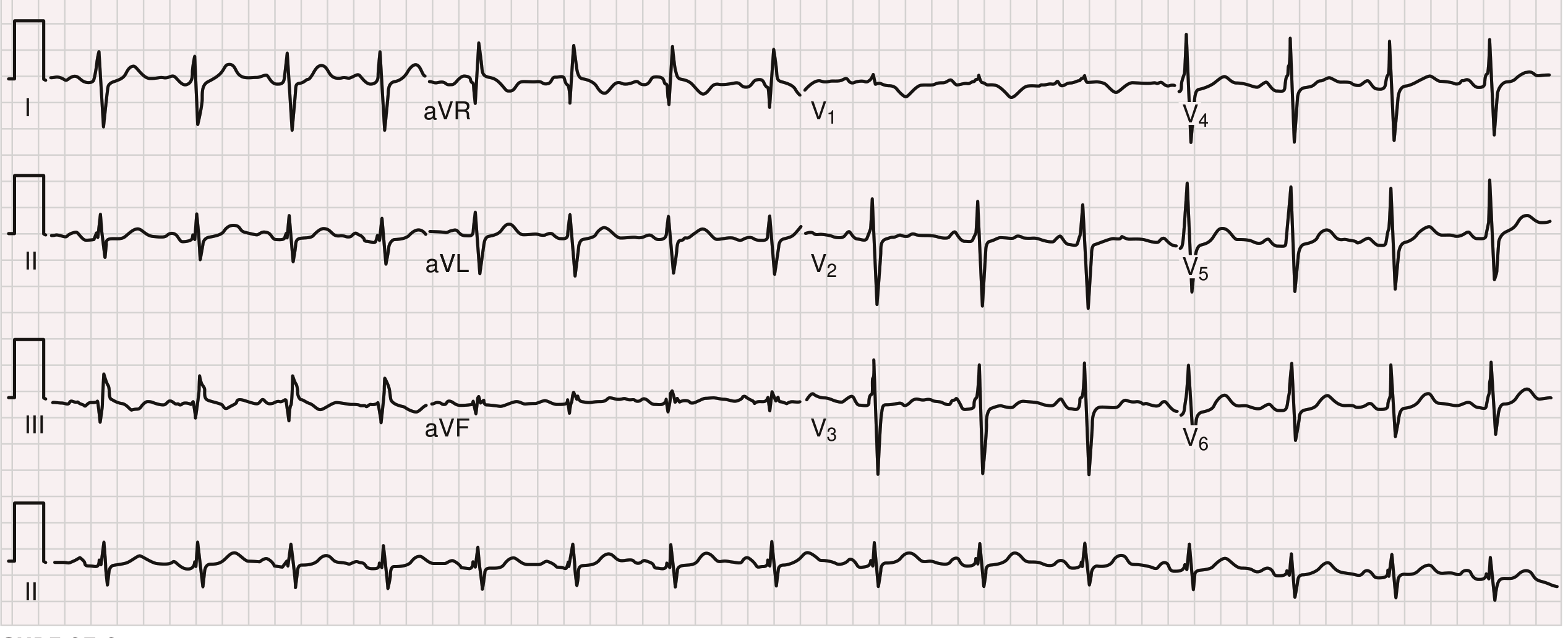 PE ECG with S1Q3T3 and incomplete RBBB (Braunwald's Heart Disease)