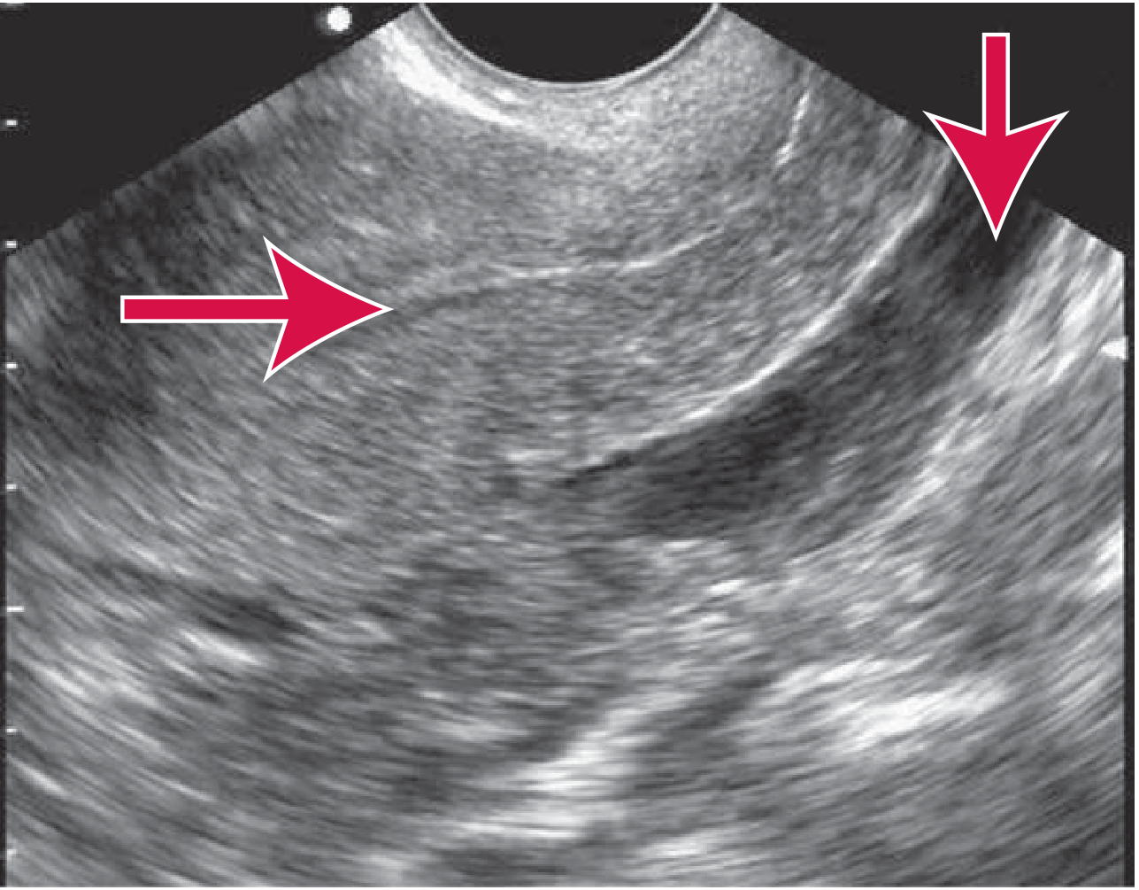 Ectopic pregnancy - empty uterus with free fluid in posterior cul-de-sac on transvaginal scan