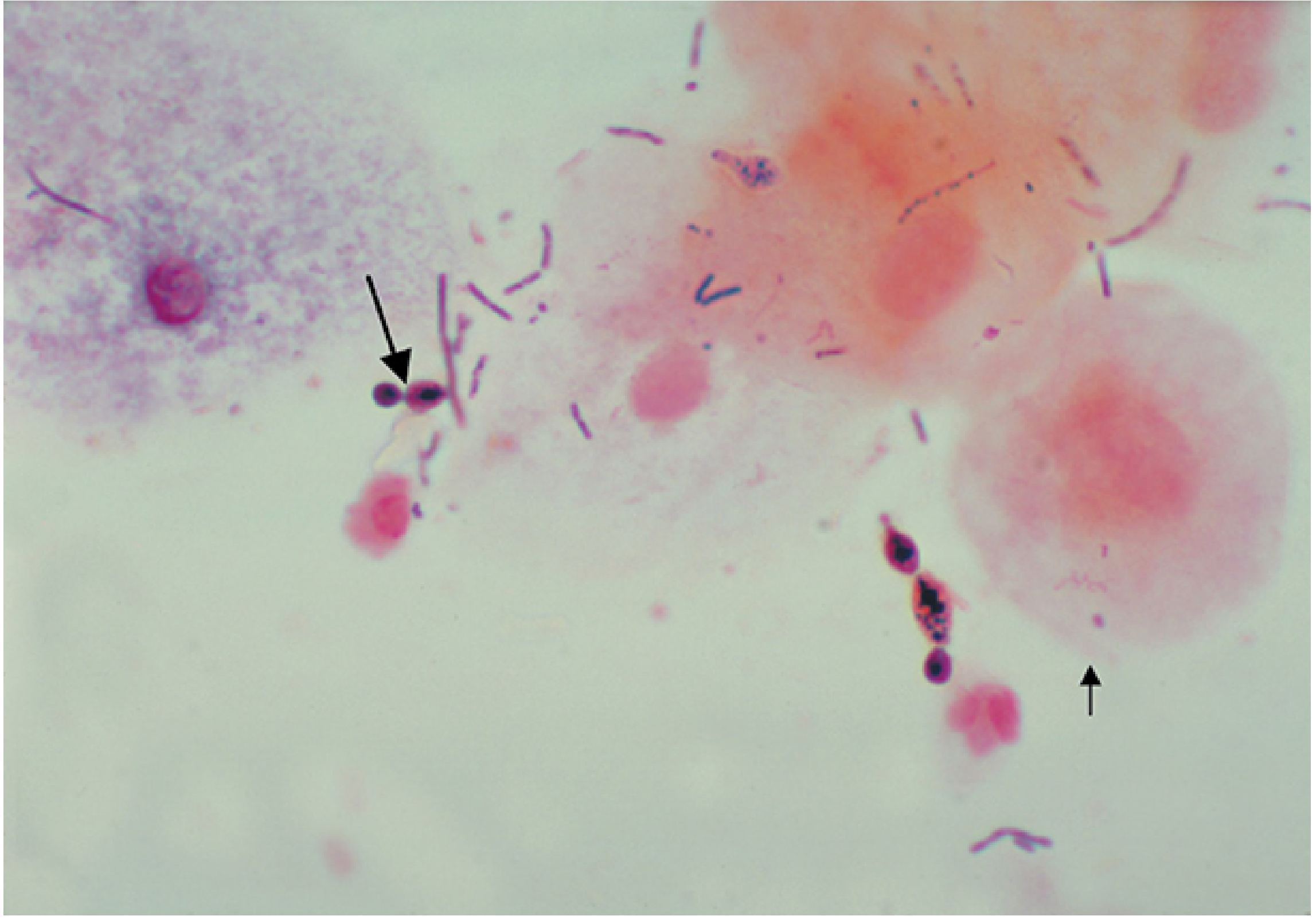 Vaginal Gram smear showing budding yeast (long arrow), epithelial cells (short arrow), and a mixture of bacterial morphologies including long Gram-positive rods (likely lactobacilli)