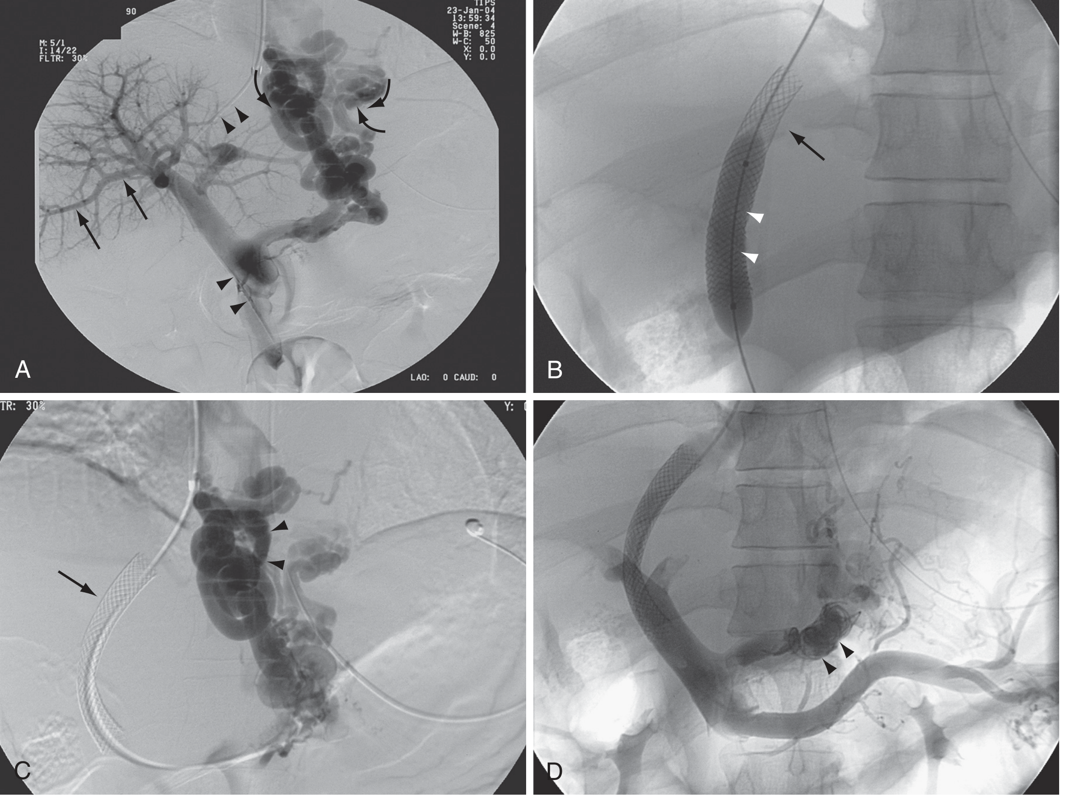 TIPSS Procedure - Fluoroscopic Images