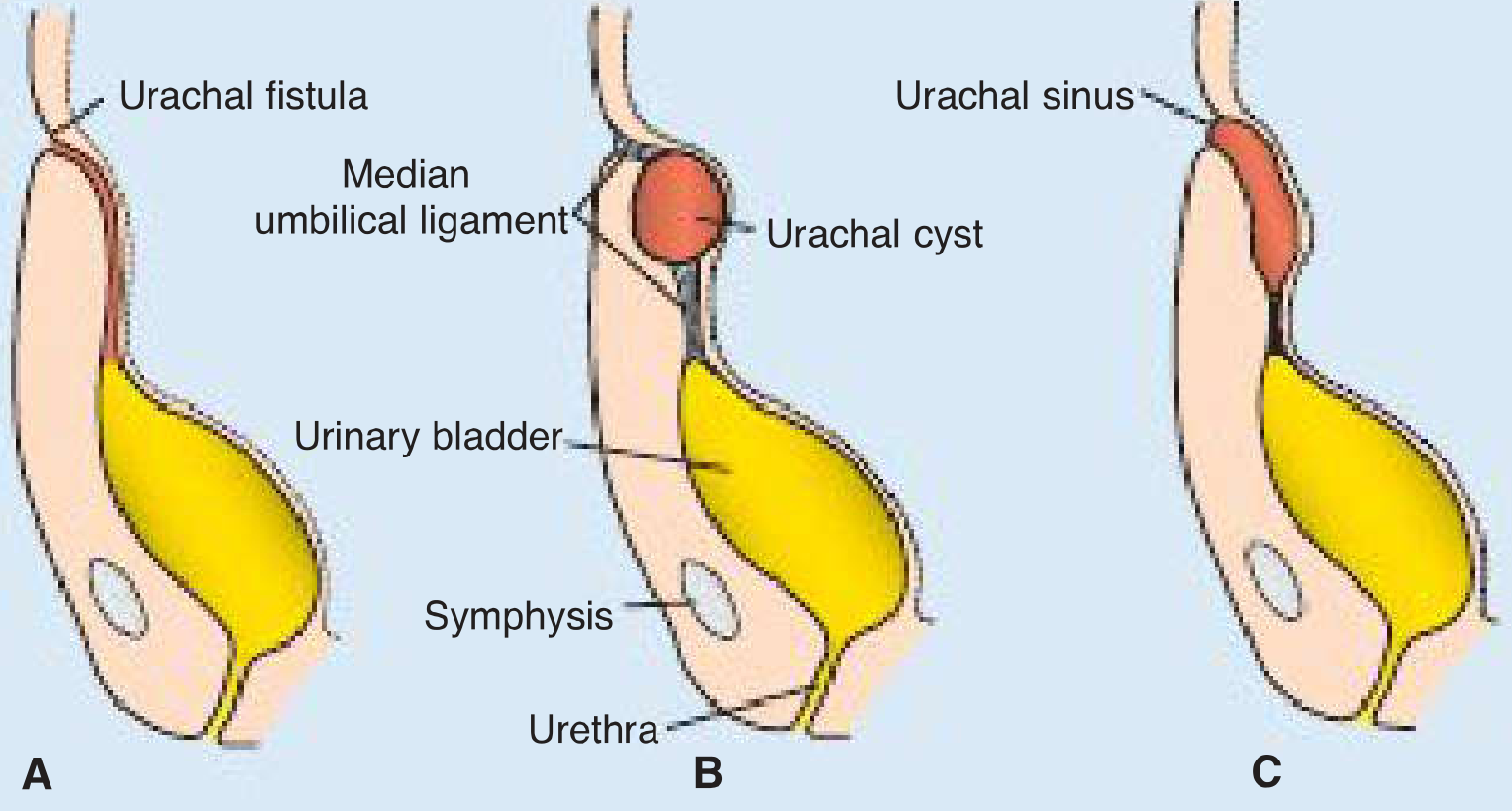 Urachal anomalies diagram - A: urachal fistula, B: urachal cyst, C: urachal sinus
