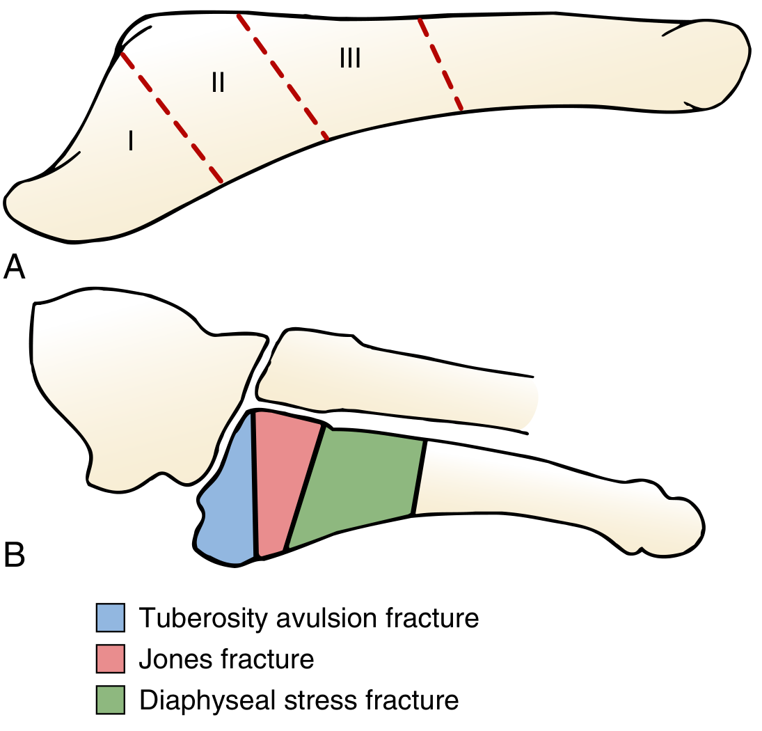 5th metatarsal fracture zones diagram showing Zones I, II, III and the corresponding fracture types: tuberosity avulsion, Jones fracture, and diaphyseal stress fracture