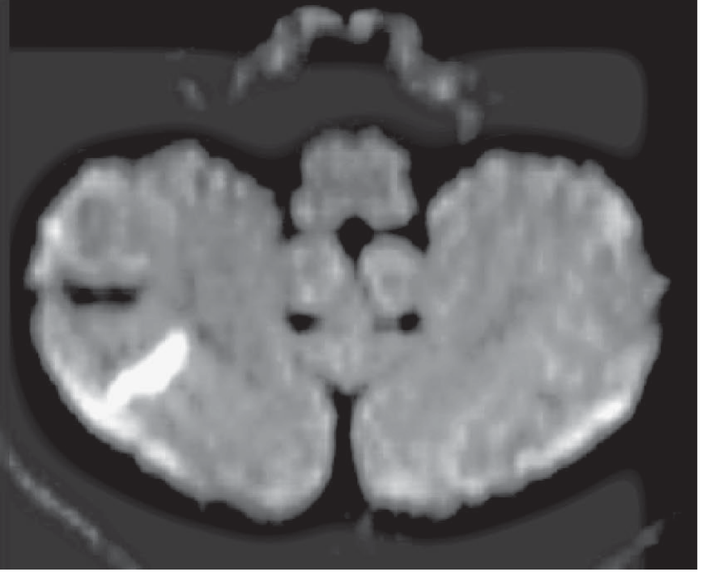 NCCT showing acute cerebellar hemorrhage - hyperdense bright white area visible in right cerebellar hemisphere