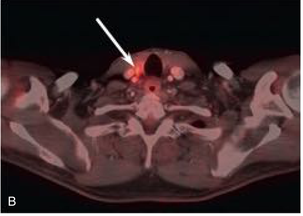 PET/CT fused image showing hot spot in lower neck