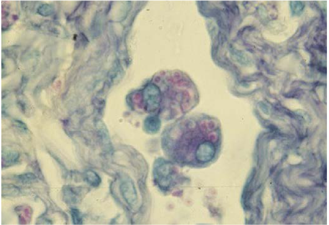Yeast cells of Histoplasma capsulatum within macrophages - small, round-to-oval intracellular yeastlike cells (H&E stain, 1000x)