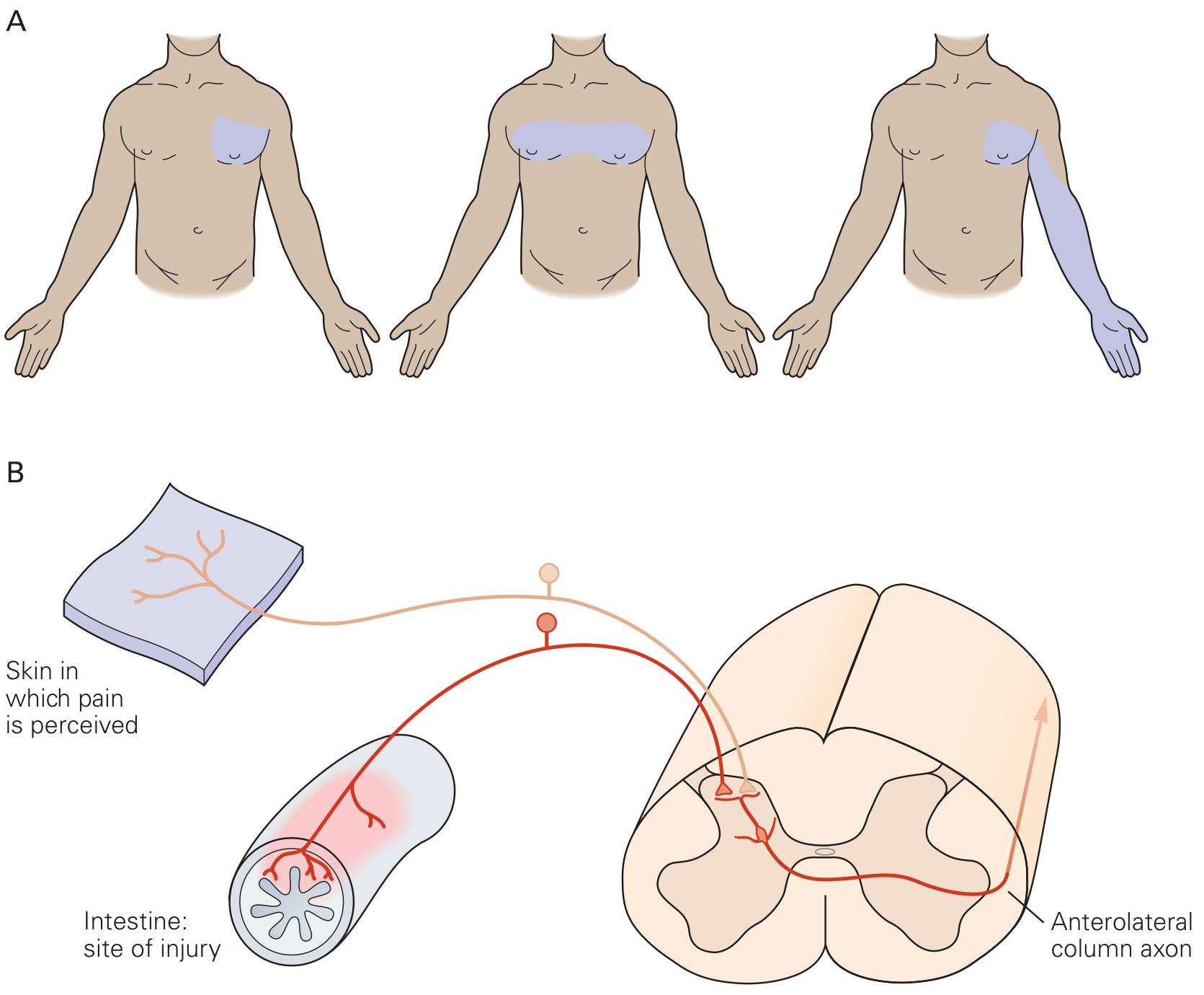 Referred pain zones from cardiac ischemia - shown in the chest and radiating down the left arm