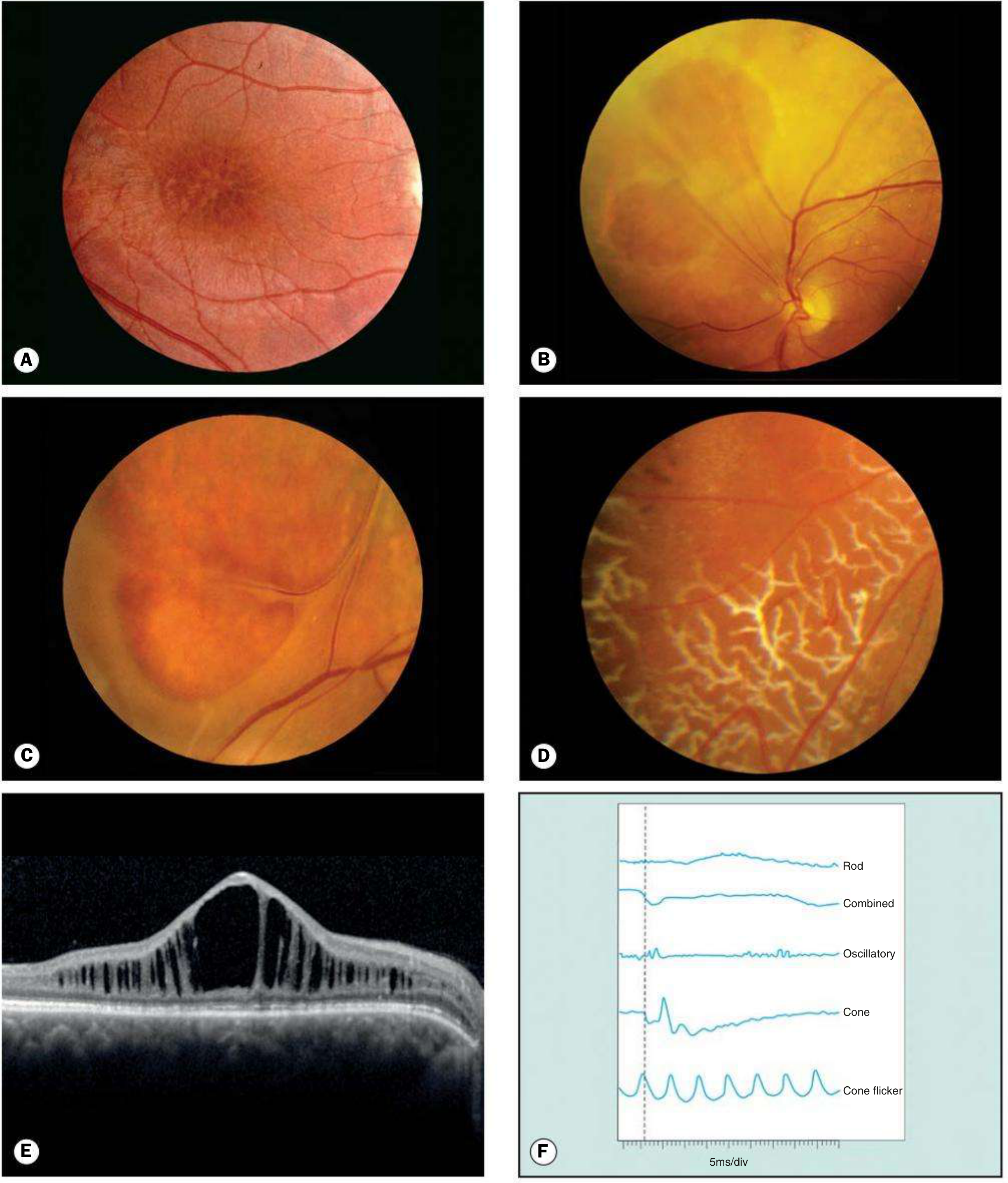Juvenile retinoschisis. (A) 'Bicycle wheel' maculopathy; (B) large oval inner leaf defects; (C) vitreous veils; (D) peripheral dendritic lesions; (E) OCT showing macular schisis; (F) ERG showing electronegative pattern