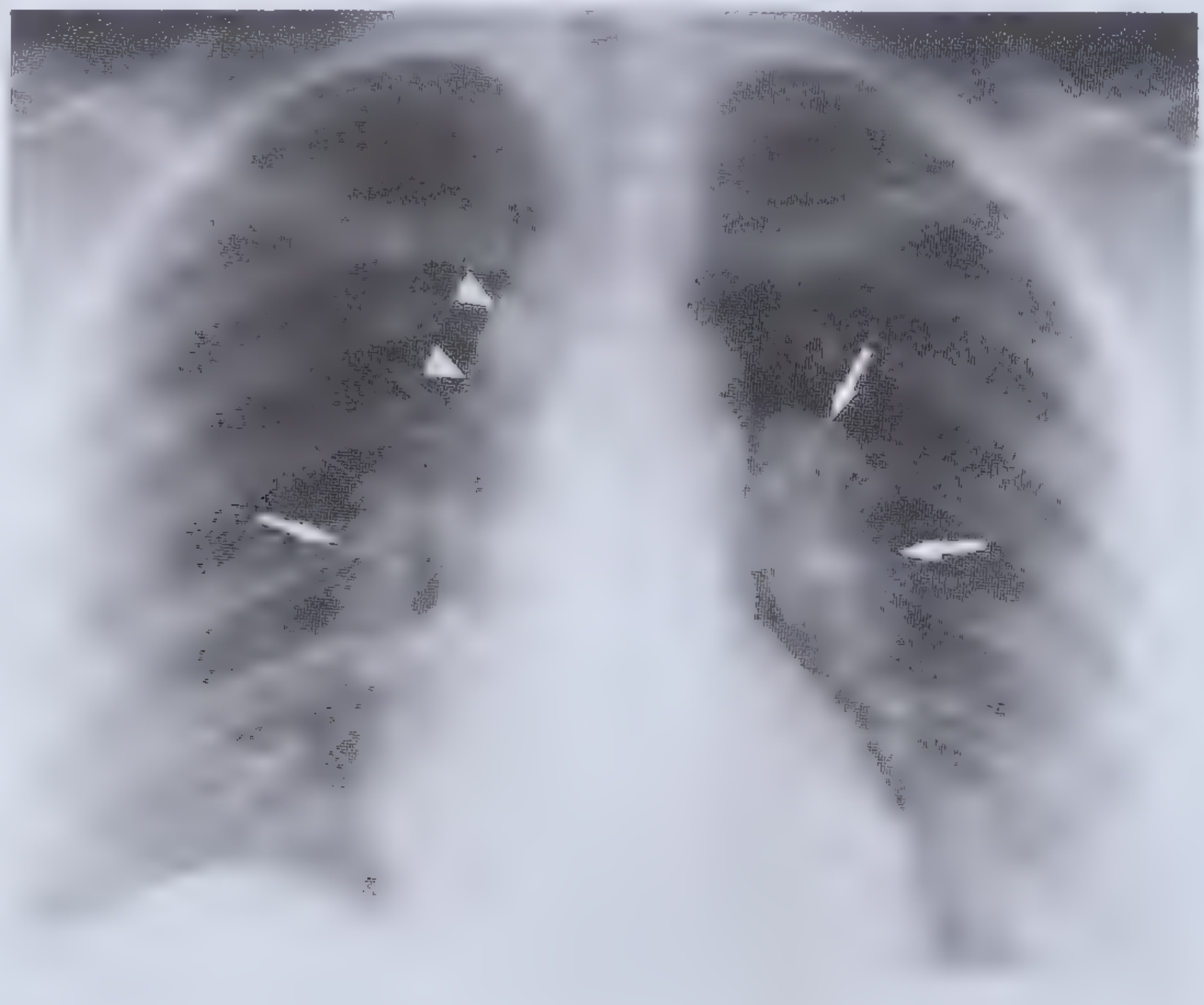 Bilateral hilar + paratracheal lymphadenopathy in sarcoidosis - Frameworks for Internal Medicine