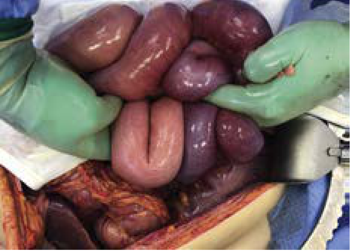 FIG. 2 — Progressive bowel ischemia