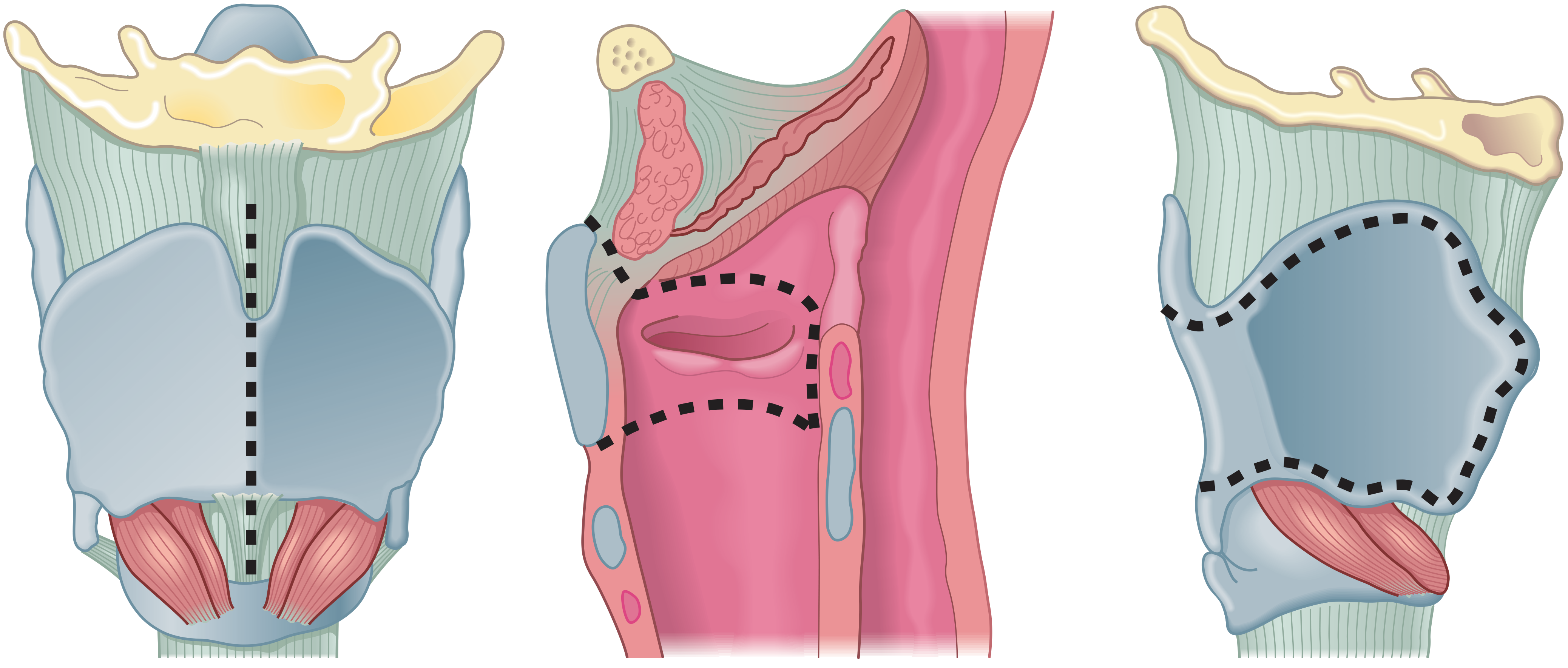 Vertical partial laryngectomy planning illustration