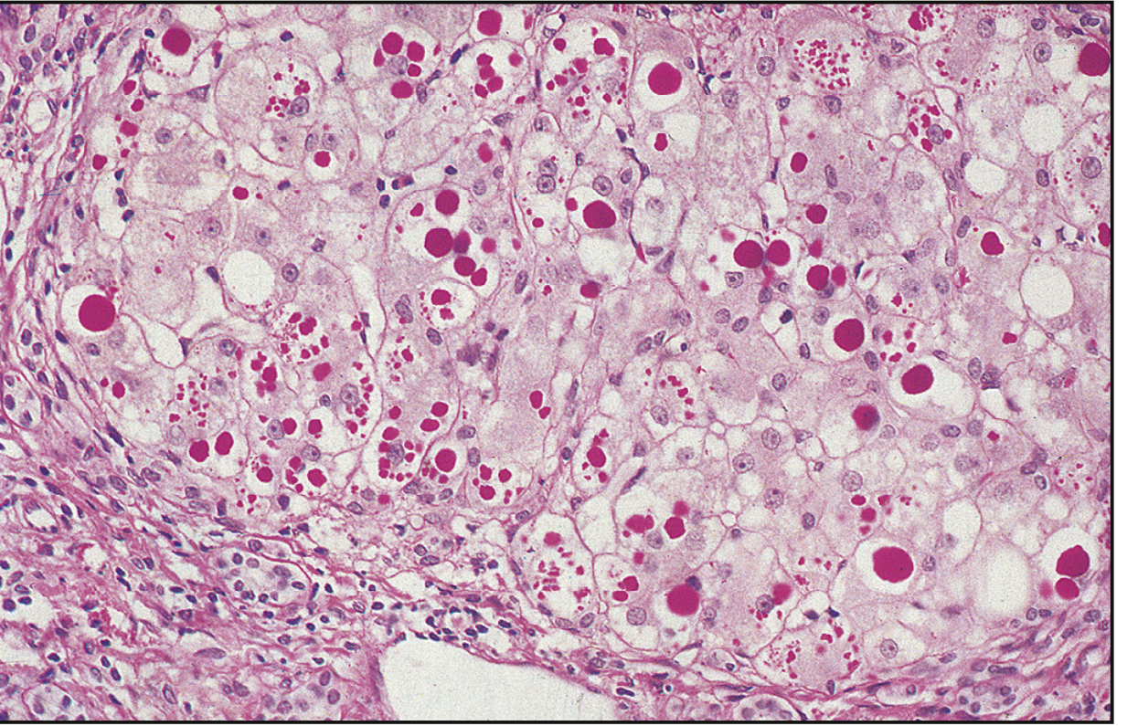 α1-AT deficiency - PAS-positive globules in hepatocytes