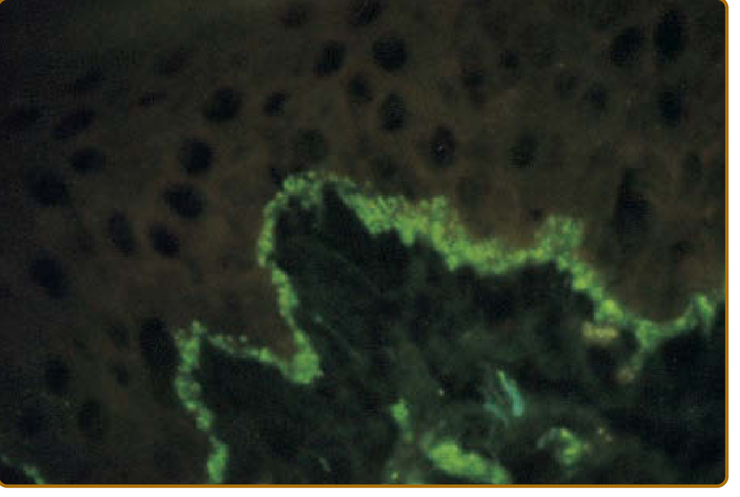 DIF of DLE - granular IgG band at DEJ