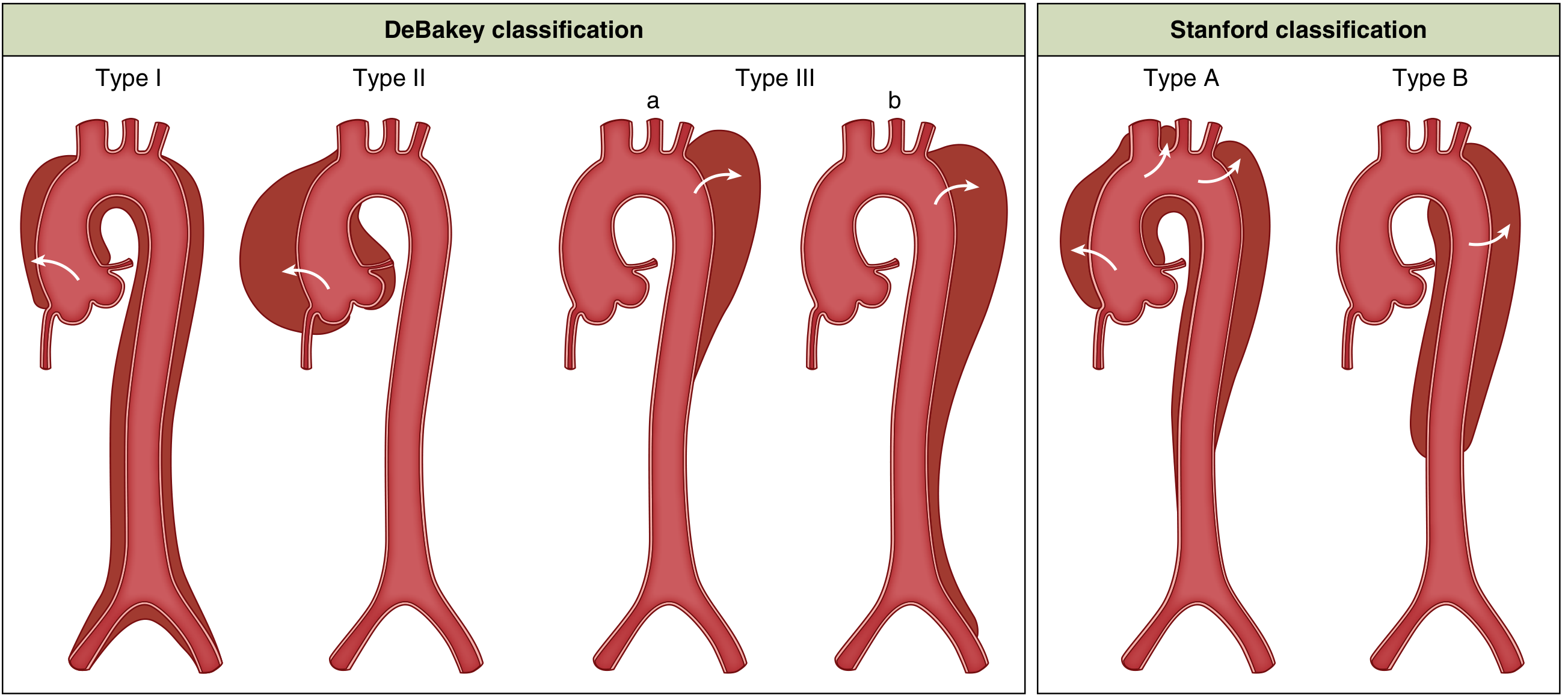 DeBakey (Type I, II, III) and Stanford (Type A, Type B) aortic dissection classifications — full illustrative diagram