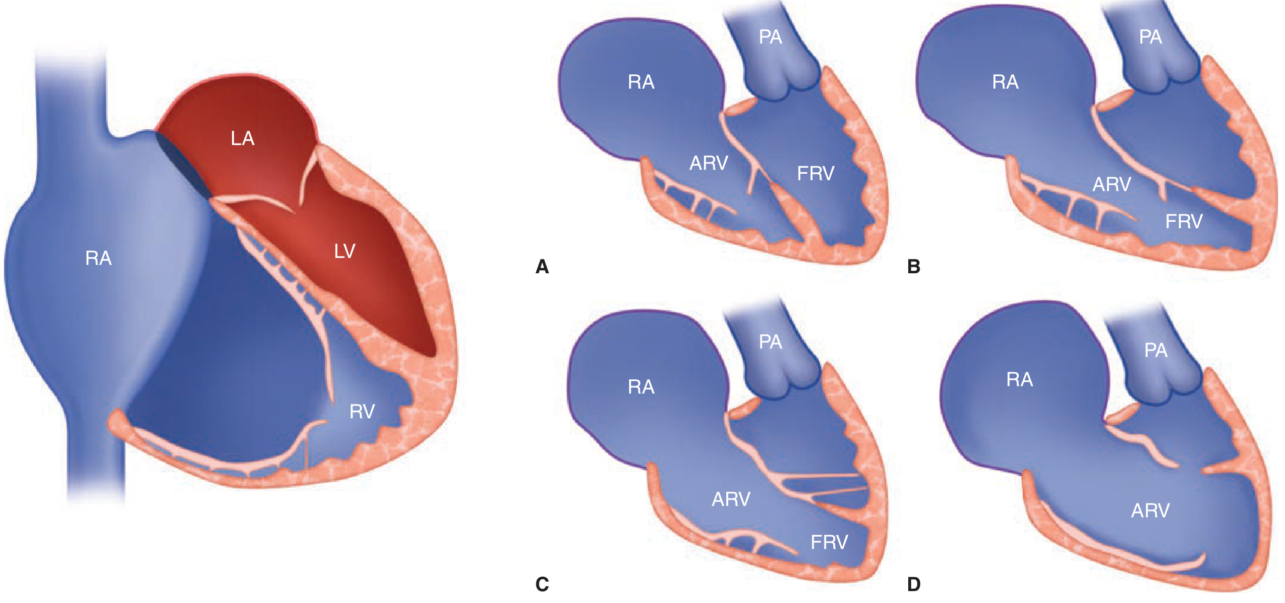 Carpentier Classification - Ebstein's Anatomy (Fuster & Hurst's The Heart)