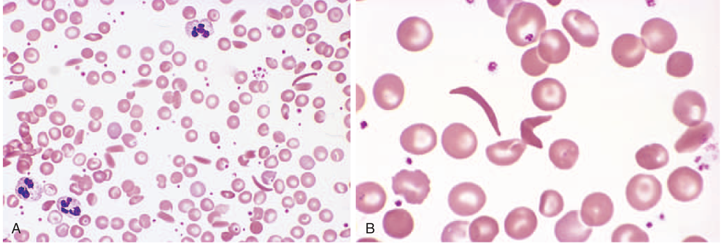 Peripheral Blood Smear in Sickle Cell Anemia