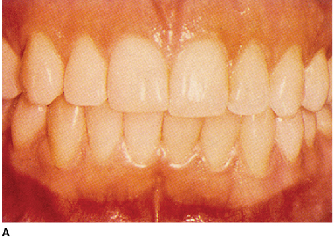 Normal gingiva