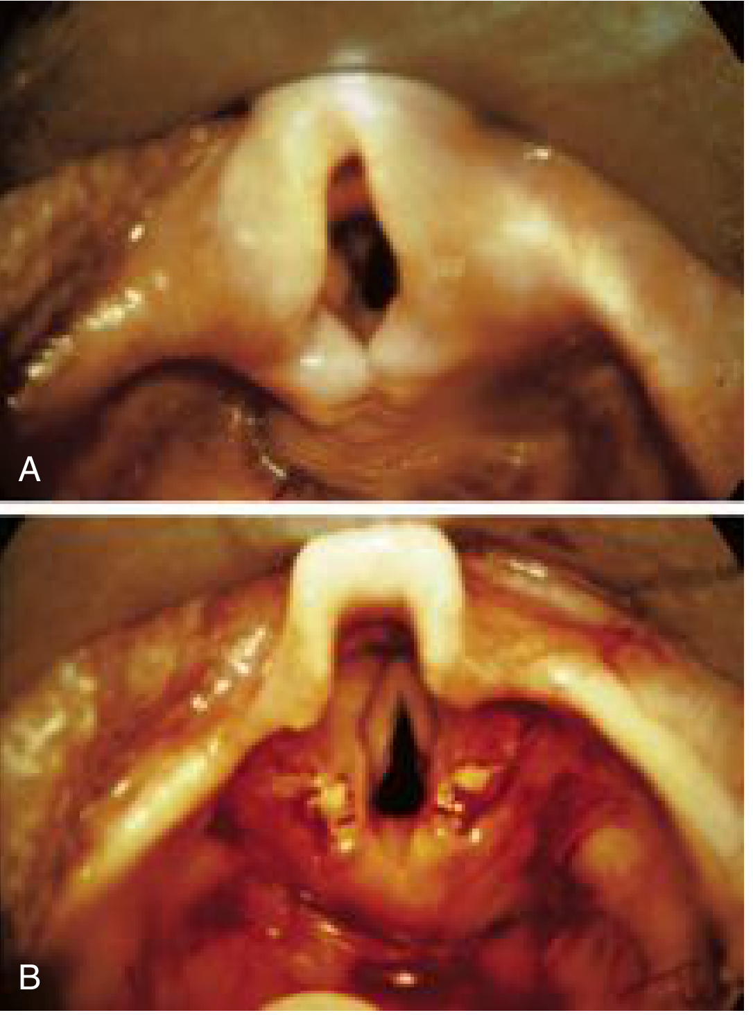 Laryngomalacia - before and after supraglottoplasty