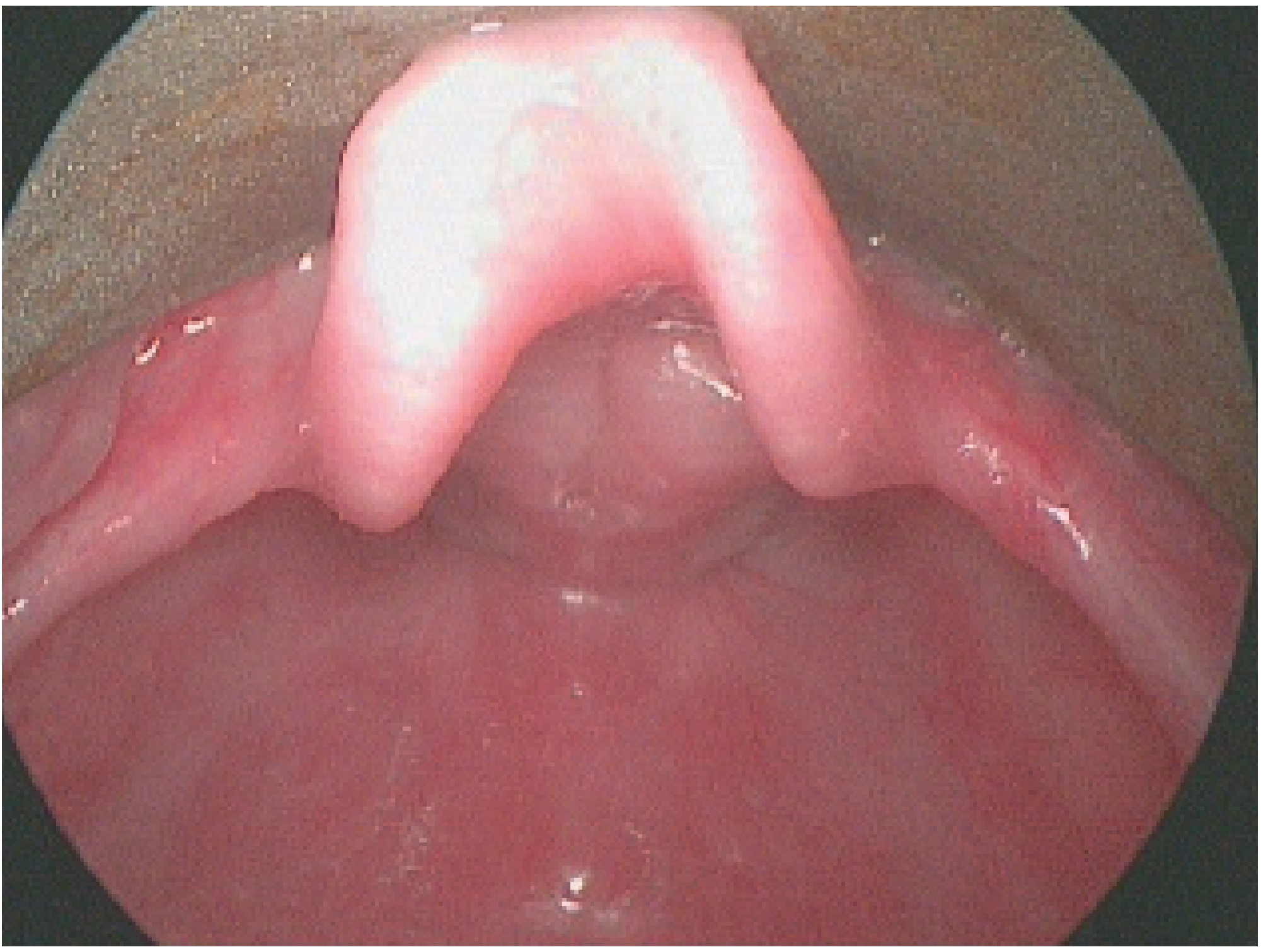 Laryngomalacia with arytenoid redundancy prolapsing into glottis