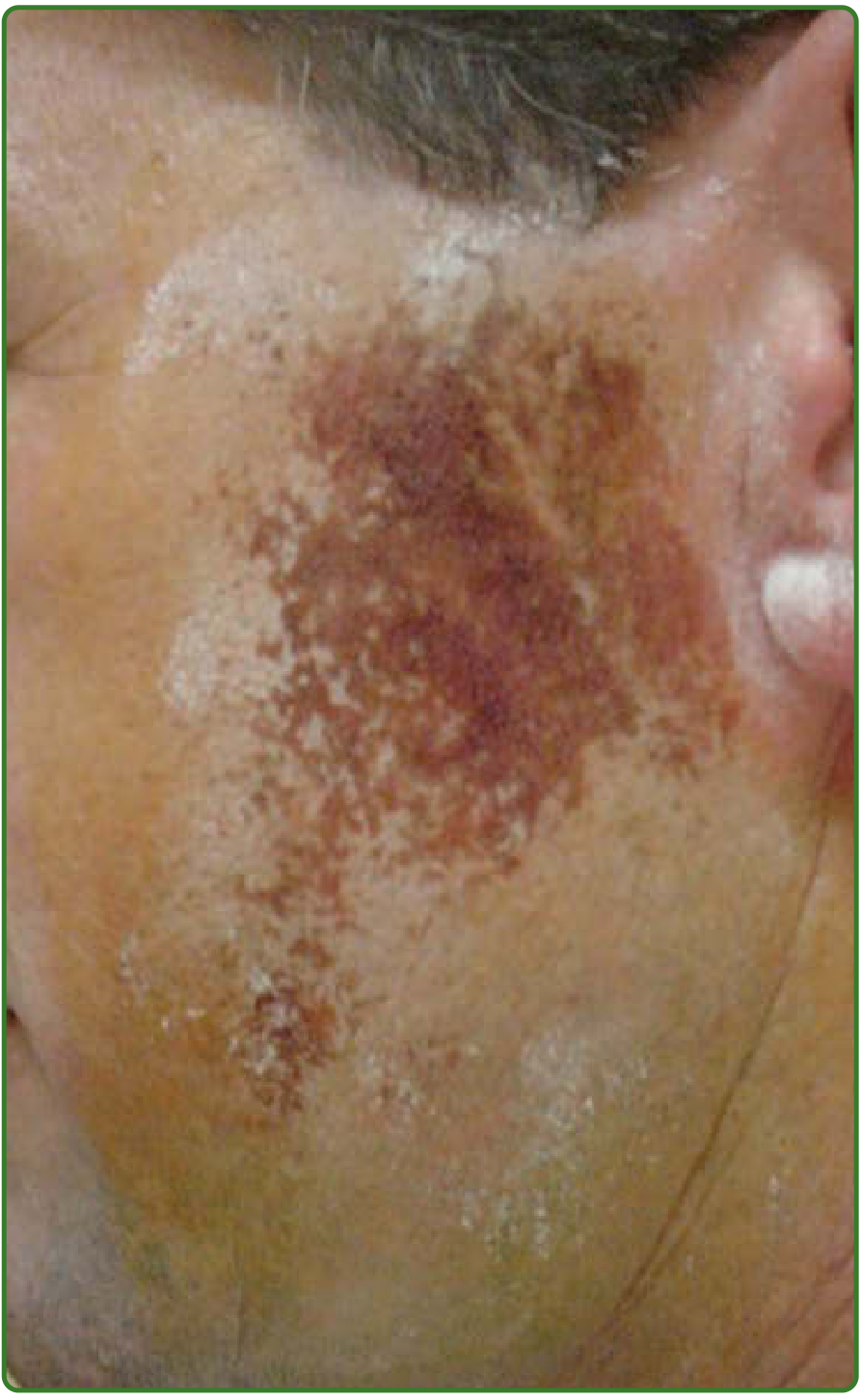 Gustatory sweating with positive starch iodine test