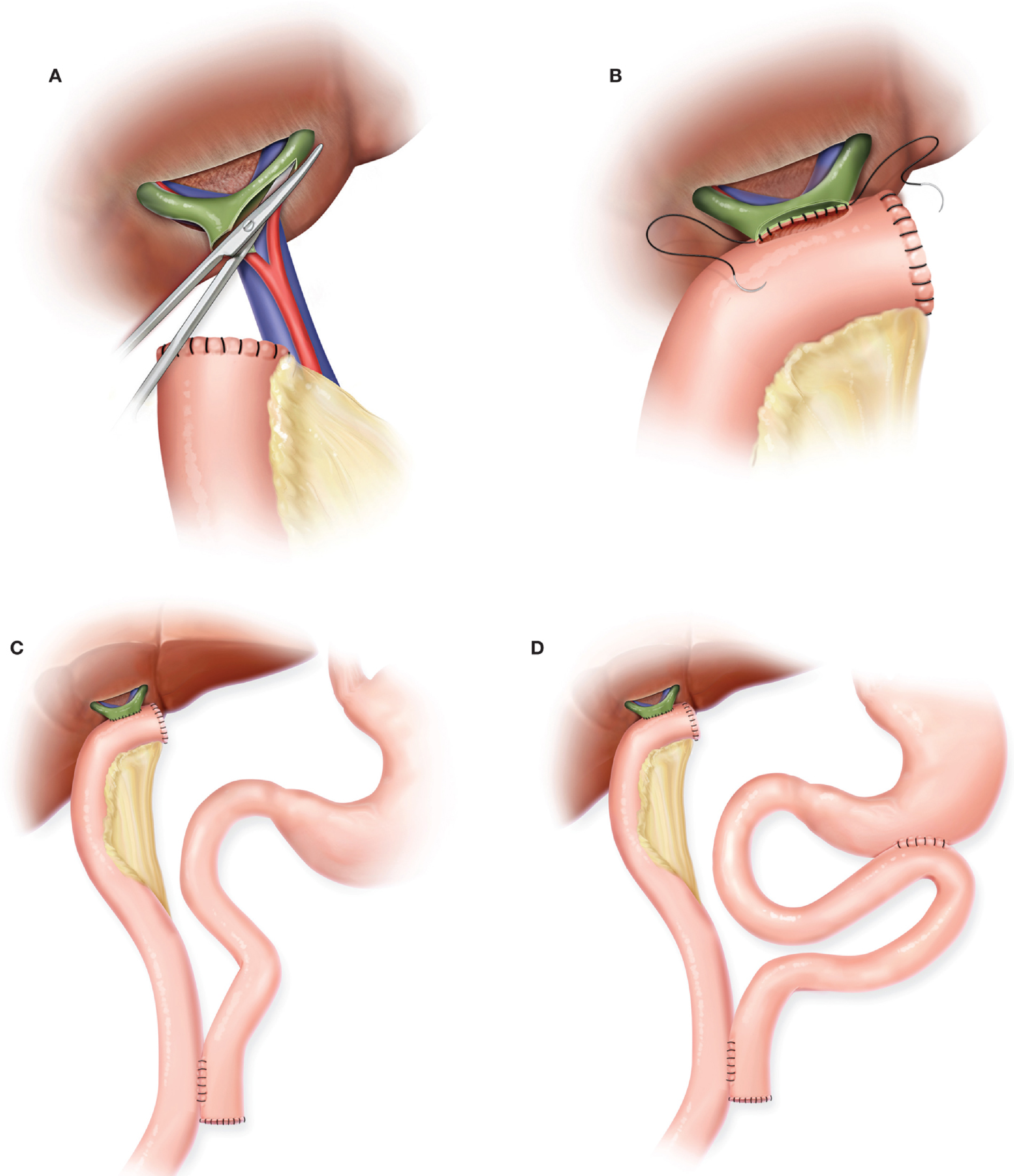 Hepp-Couinaud hepaticojejunostomy construction steps A-D