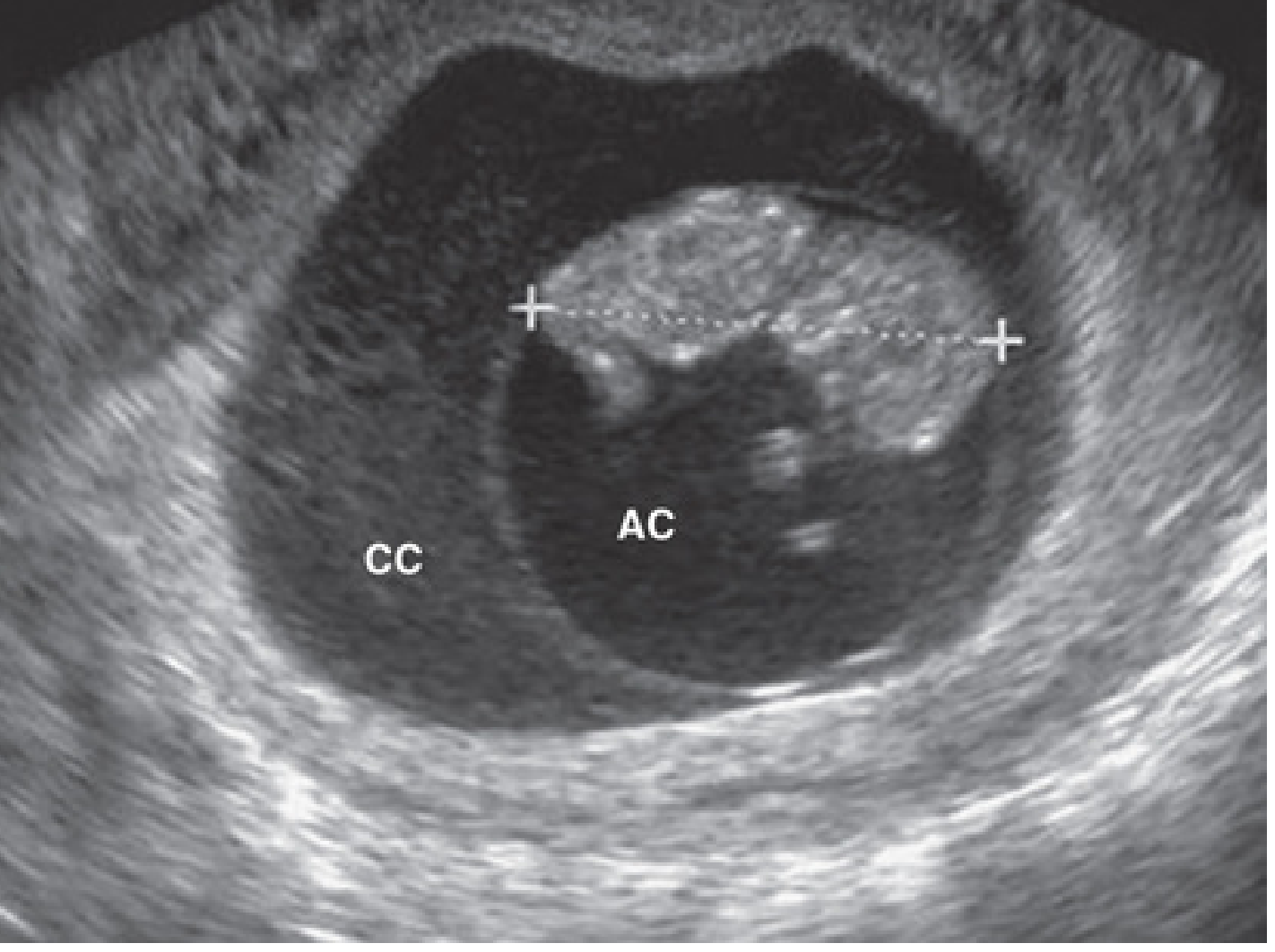 Ultrasound image of 9-week fetus showing the amniotic cavity (AC) and chorionic cavity (CC), crown-rump length 4.2 cm